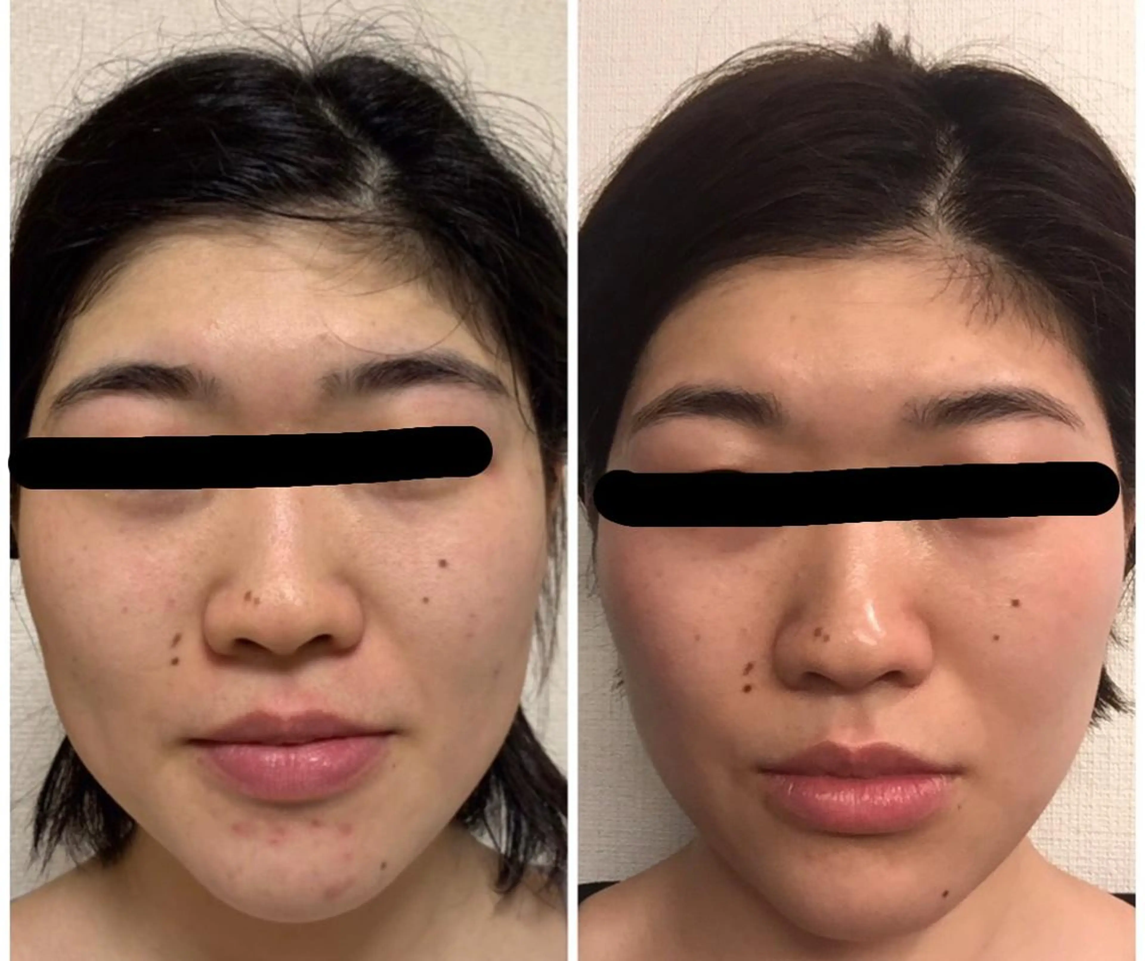 【小顔・リフトアップ】フェイシャルコース 60分の写真