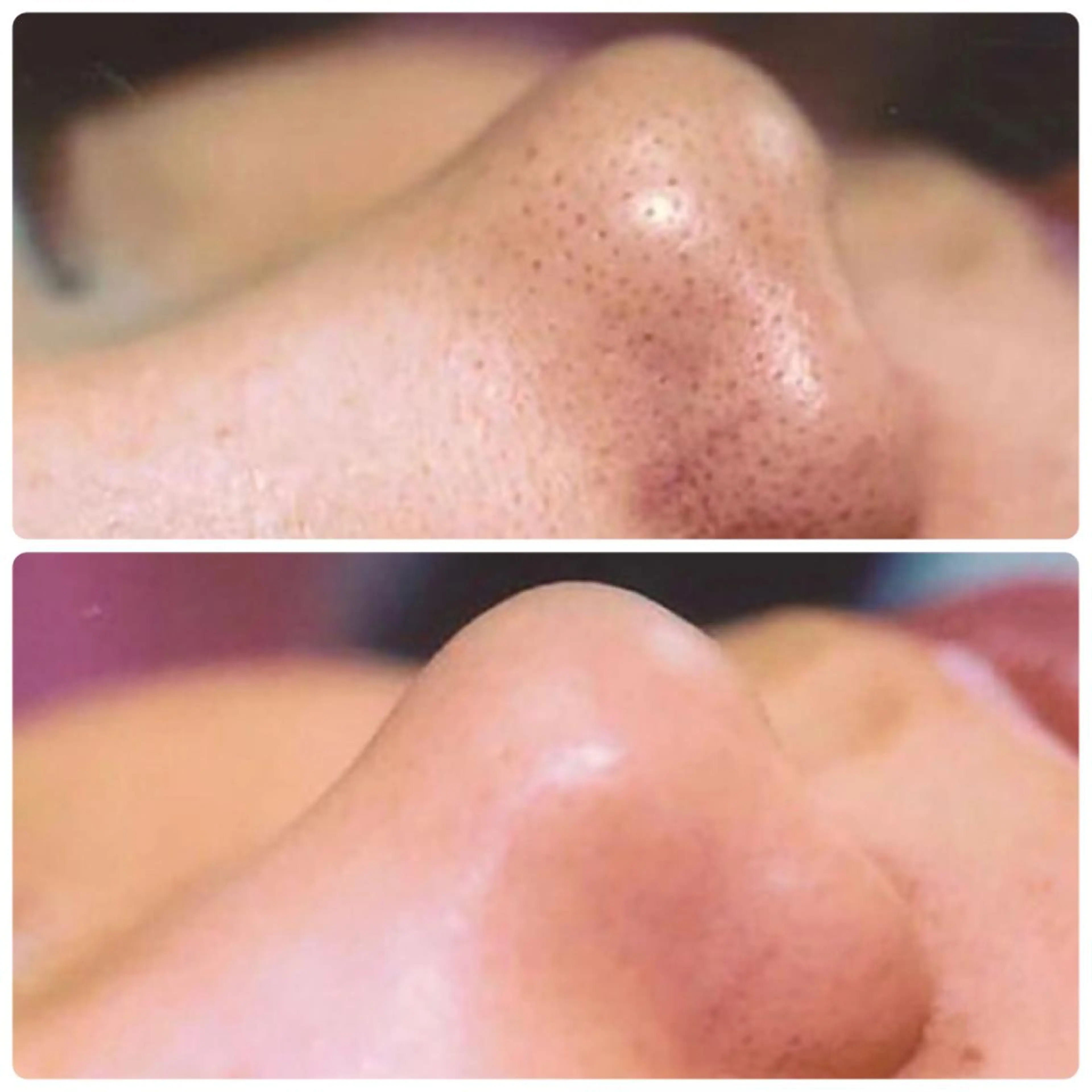 毛穴レス！小鼻・顎まわりをツルツルに♪【特許取得生コラフェイシャル】+生コライオン導入＋イチゴ鼻ケア※FAITH使用の写真