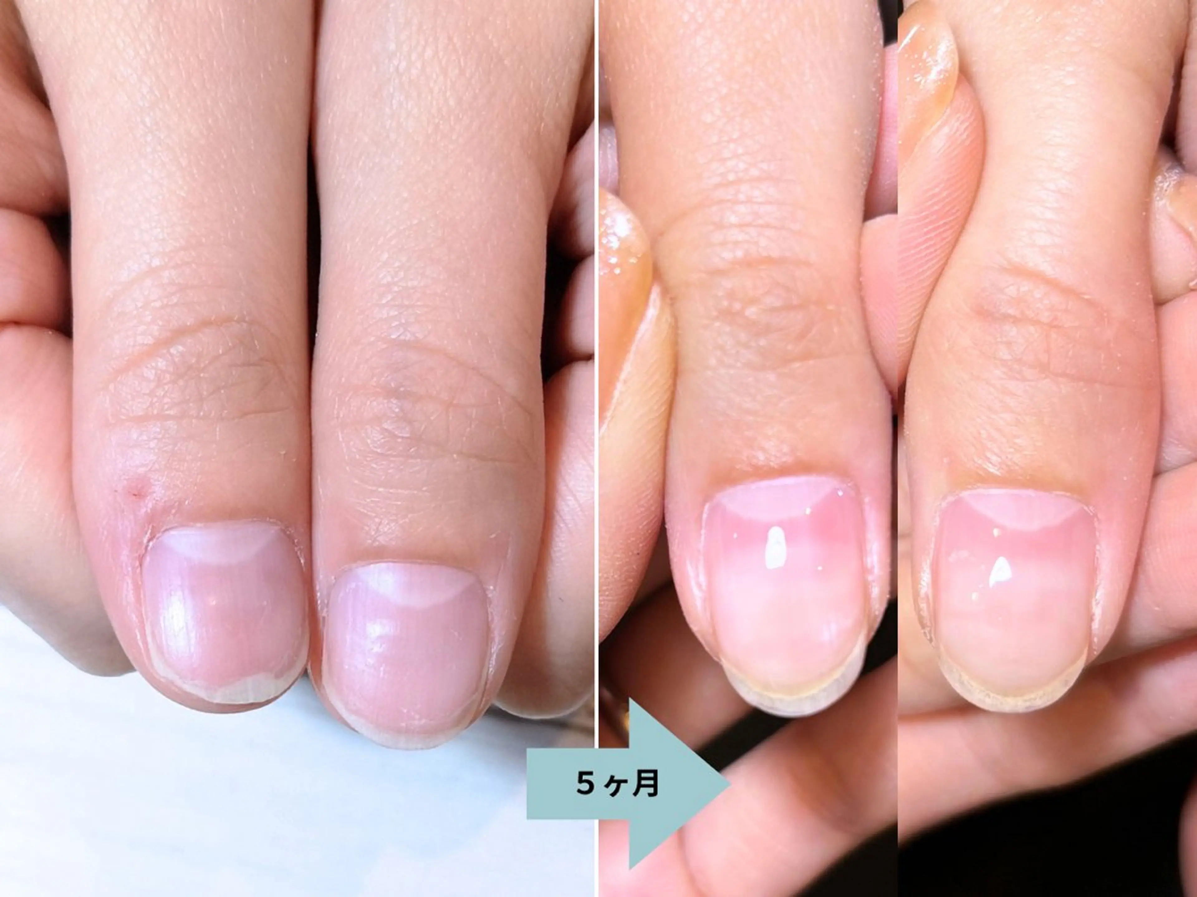 ネイル 深爪矯正・自爪育成 ネイルサロンアモここのネイルデザイン