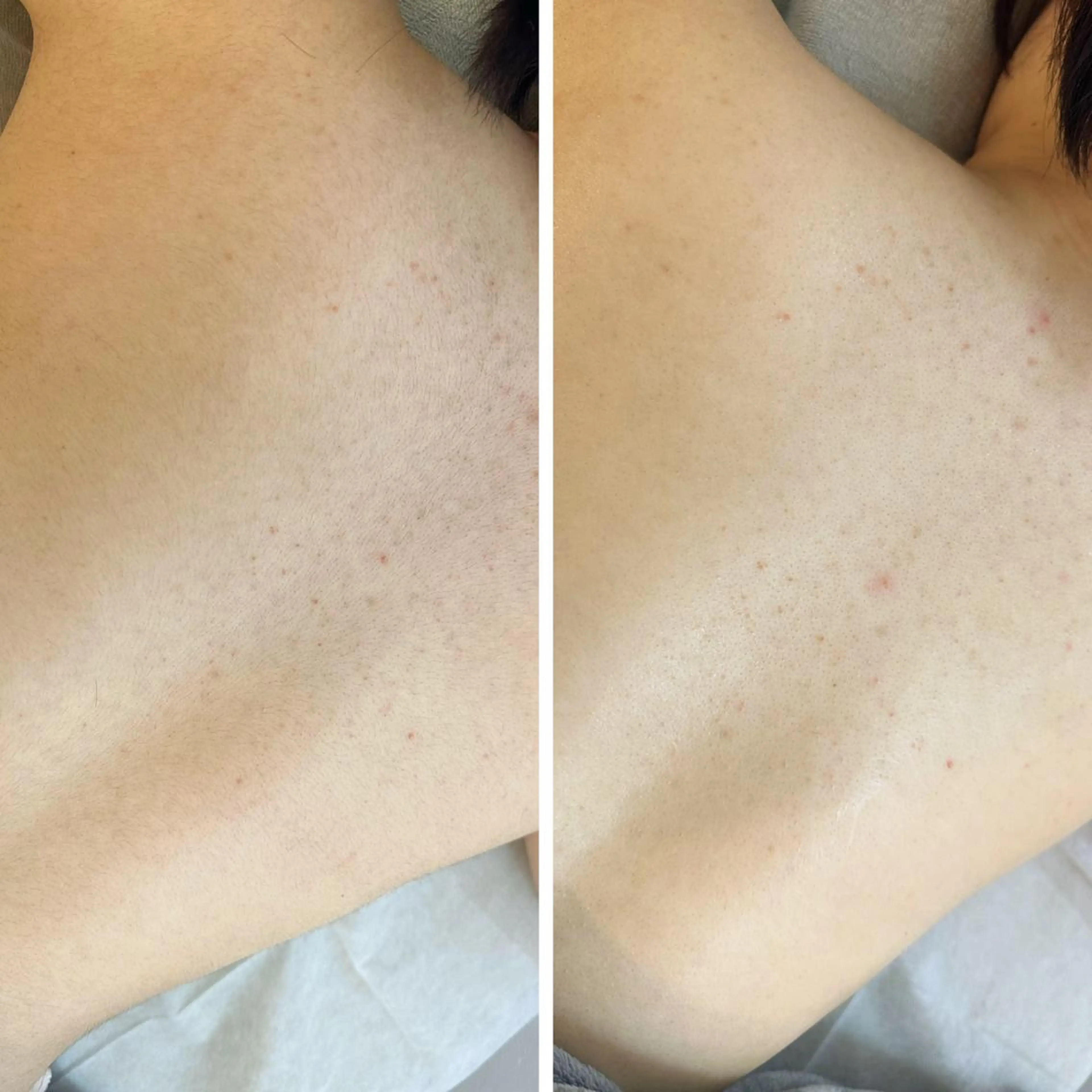 うなじ脱毛/美肌脱毛 LABELのエステ・リラクイメージ