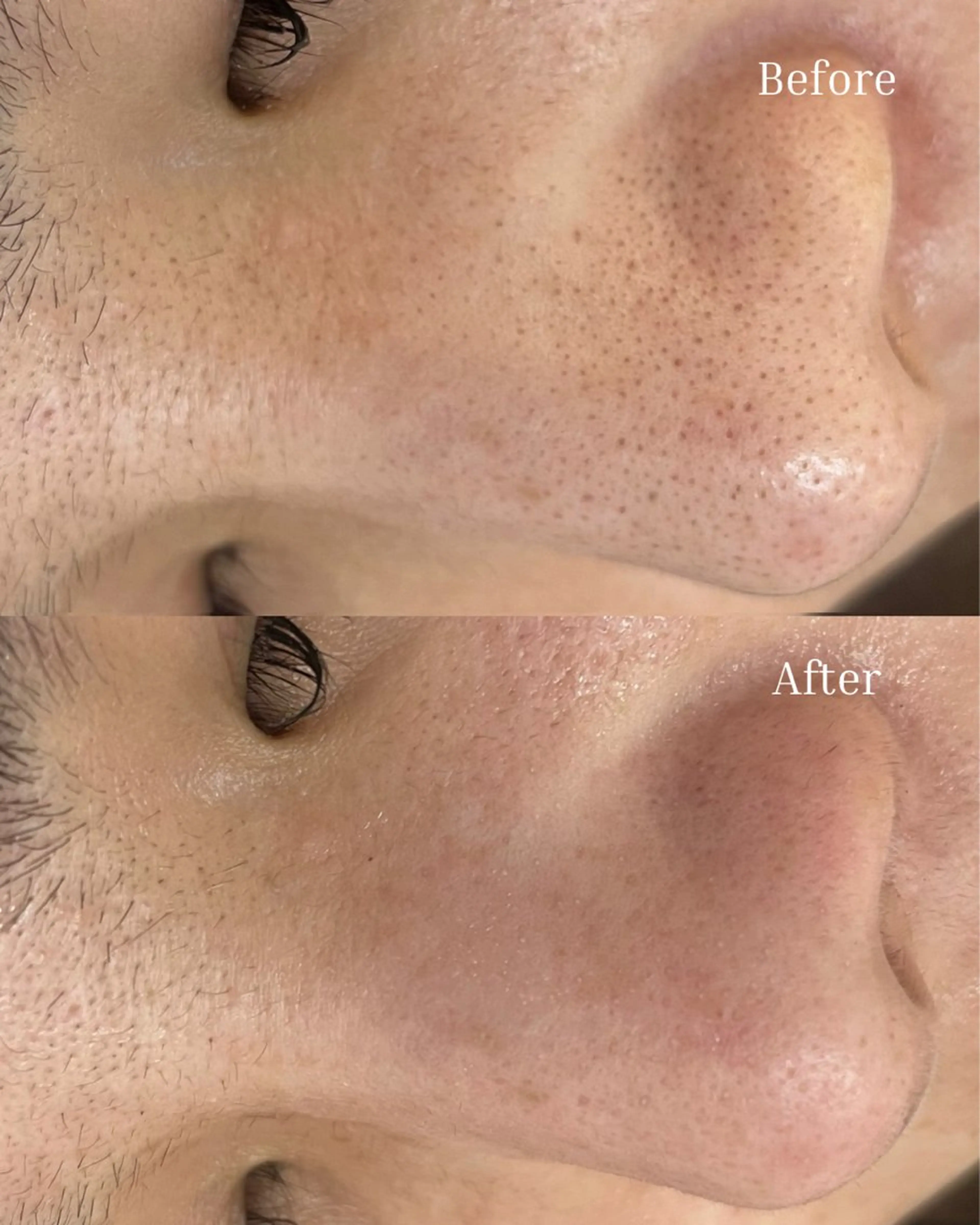 【12月限定❗️ニキビ・毛穴の黒ずみにはこれ❗️】ハーブ×毛穴吸引￥12000の写真