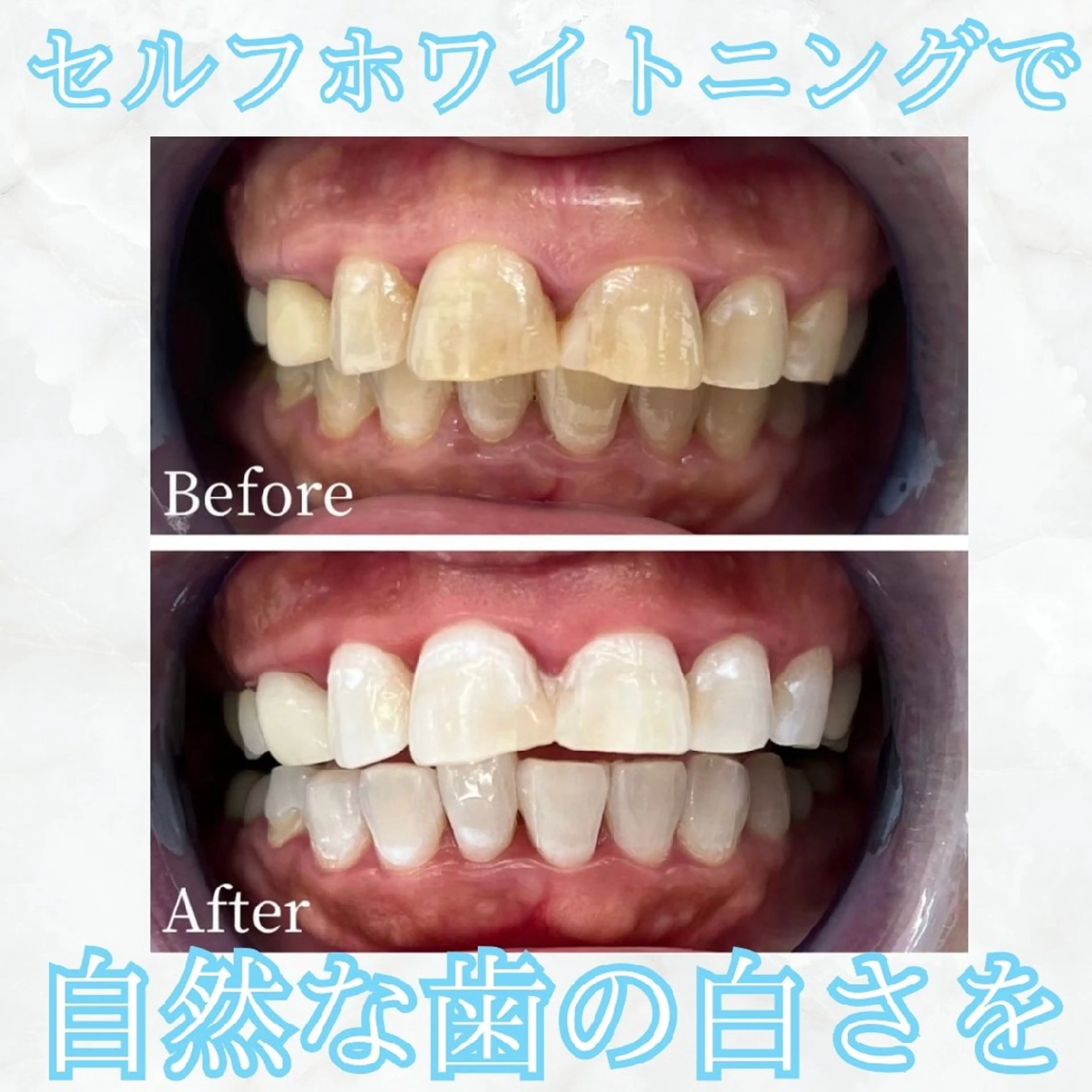 当日限定💡セルフホワイトニング【5980円→1880円】30分照射の写真