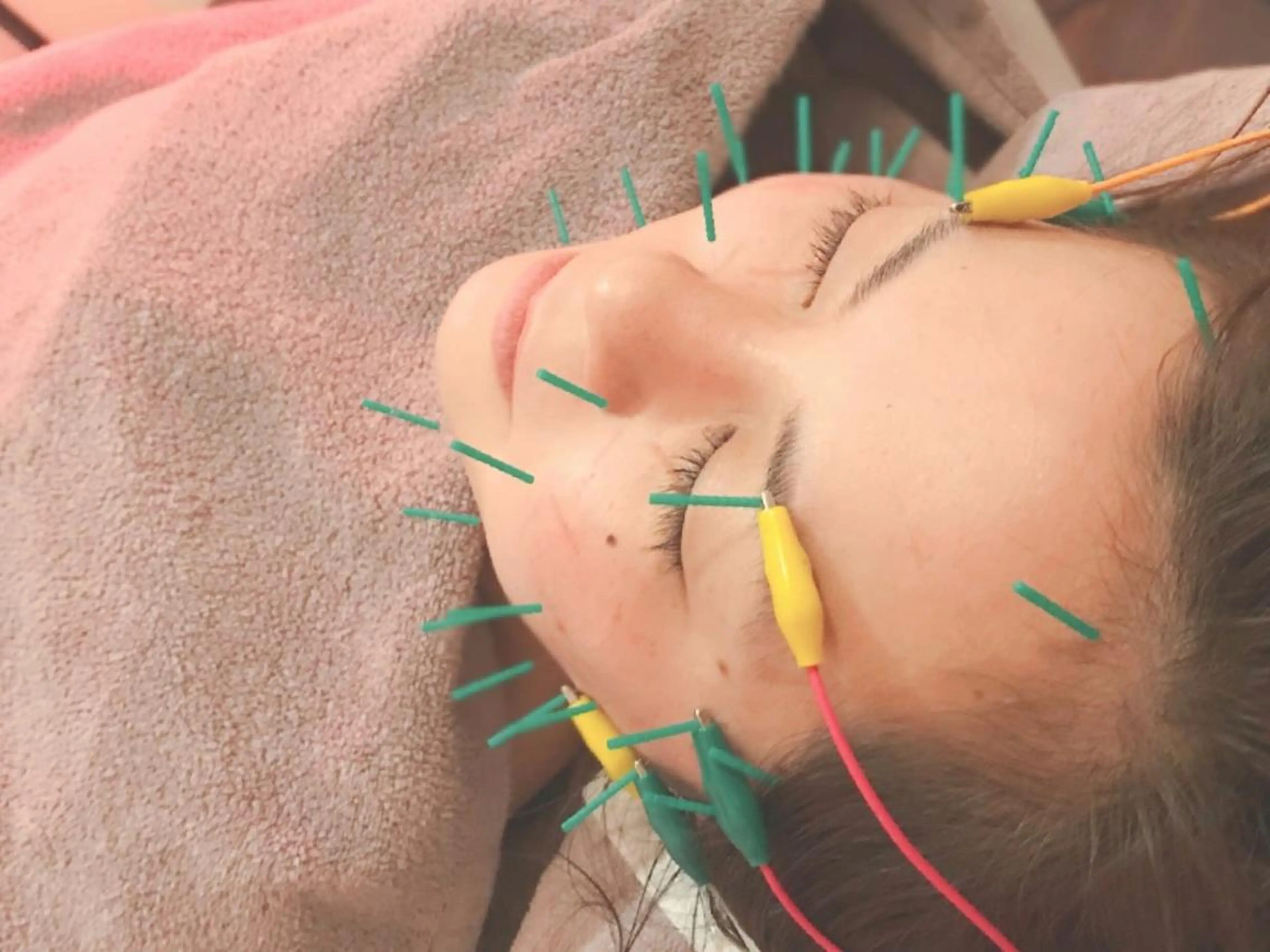 【回数券8600円お得】電気で小顔引き締め美容鍼3回(カウンセリング+美容鍼+デコルテ鍼or自律神経整え鍼+美顔マッサ)の写真