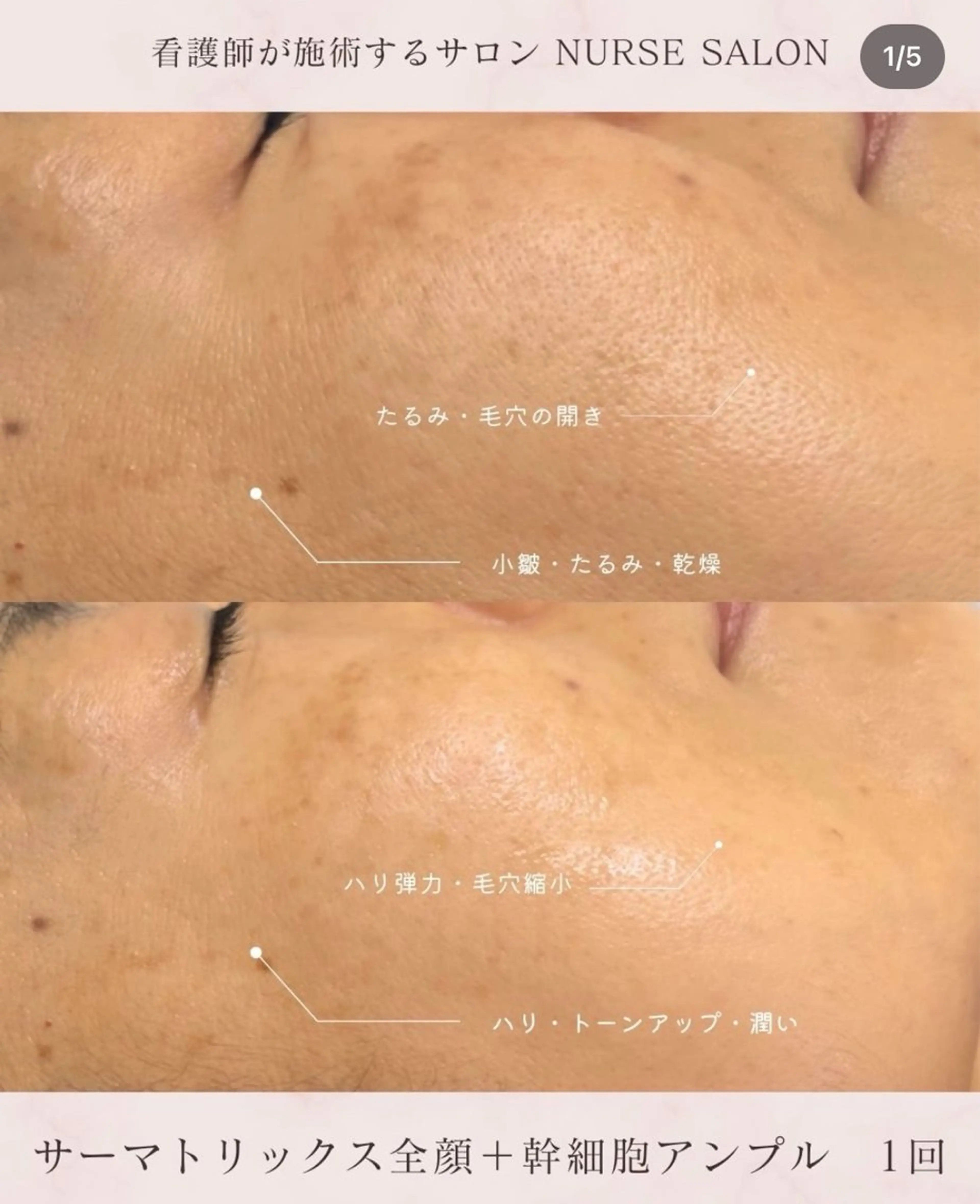 美肌・小顔専門🪄 看護師施術/松﨑のエステ・リラクイメージ