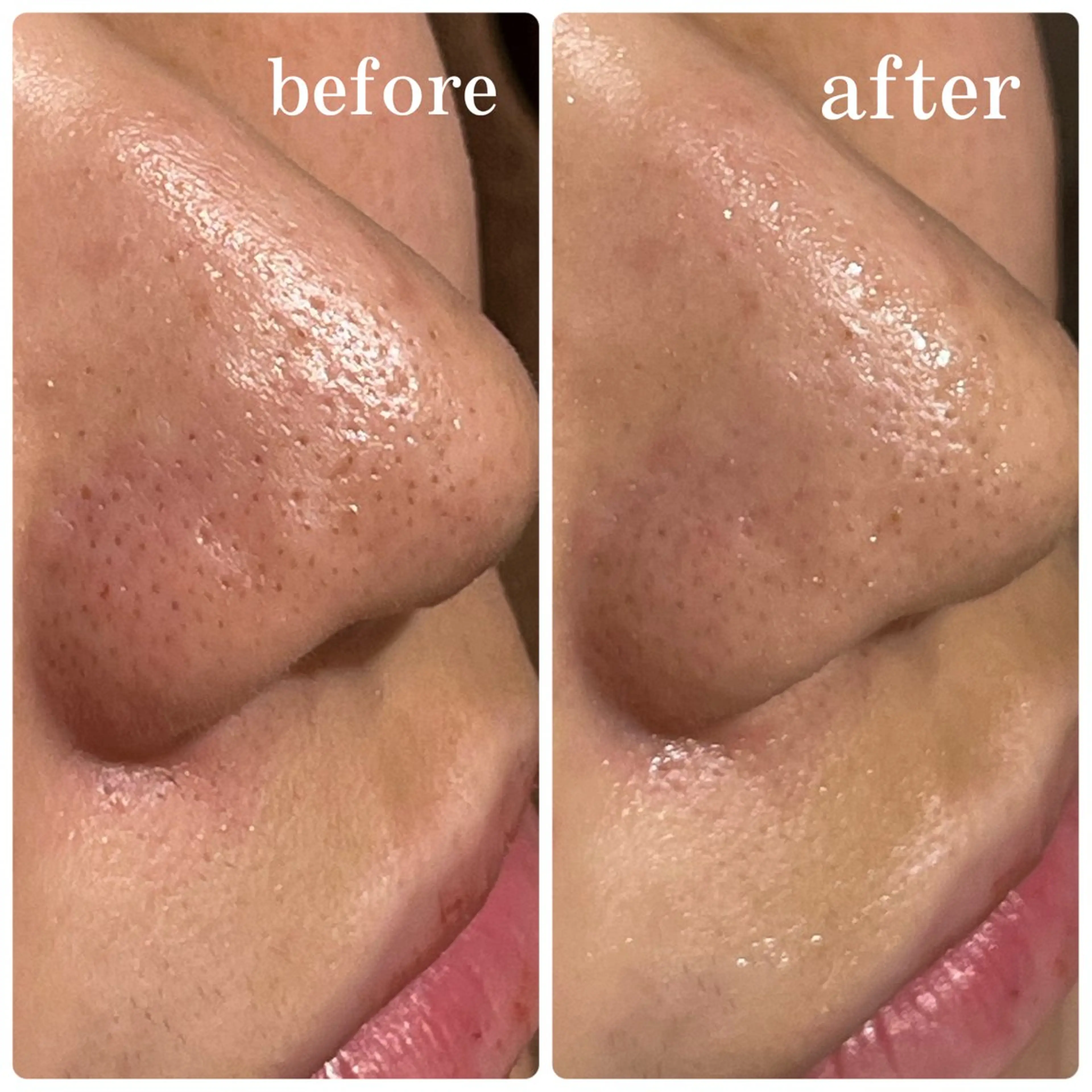 【黒ずみ/毛穴/ニキビが気になる方へ】肌改善フェイシャルの写真