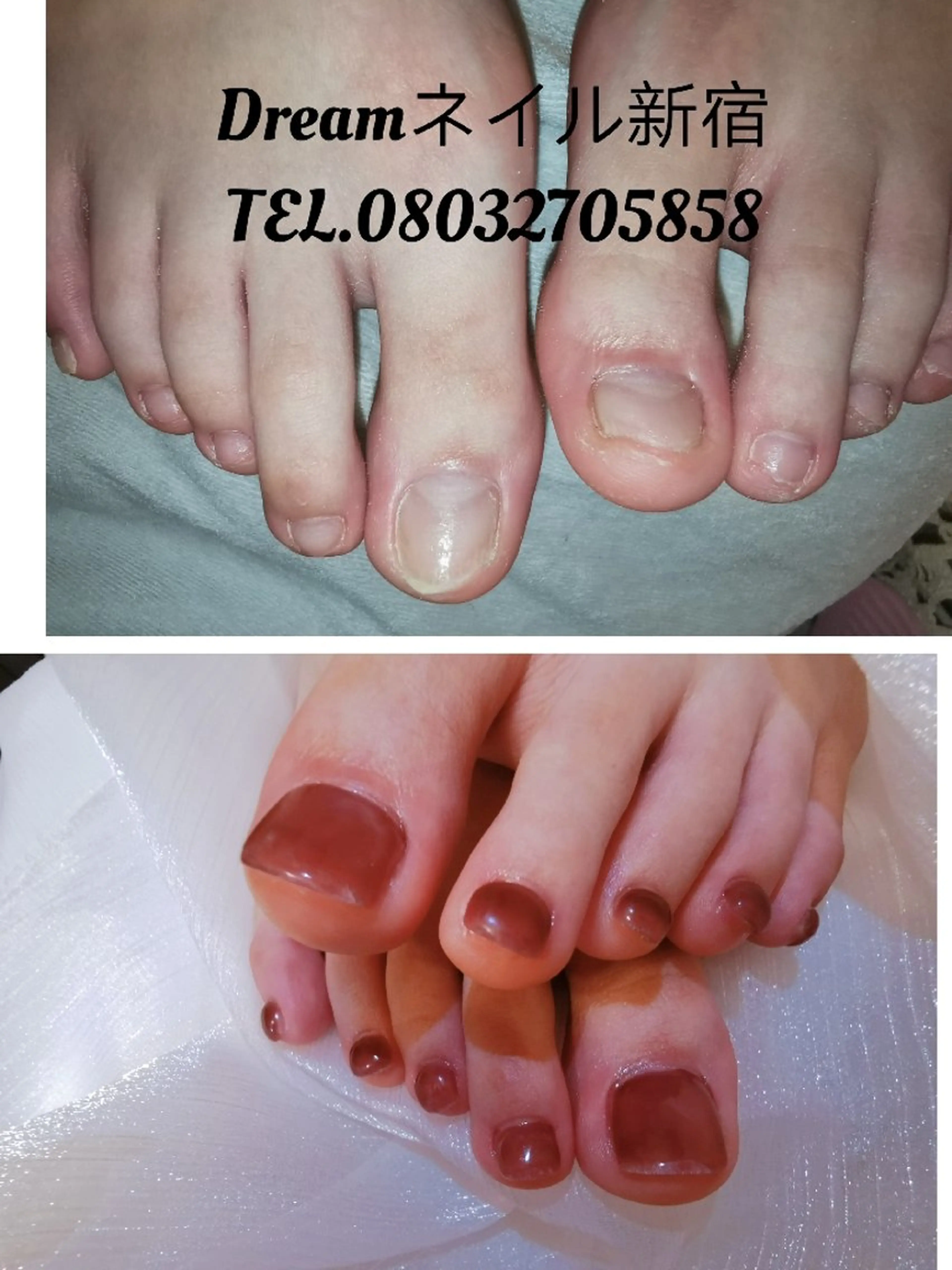 ネイル フットネイル ネイリストゆか💅 長さだし、深爪矯正のネイルデザイン