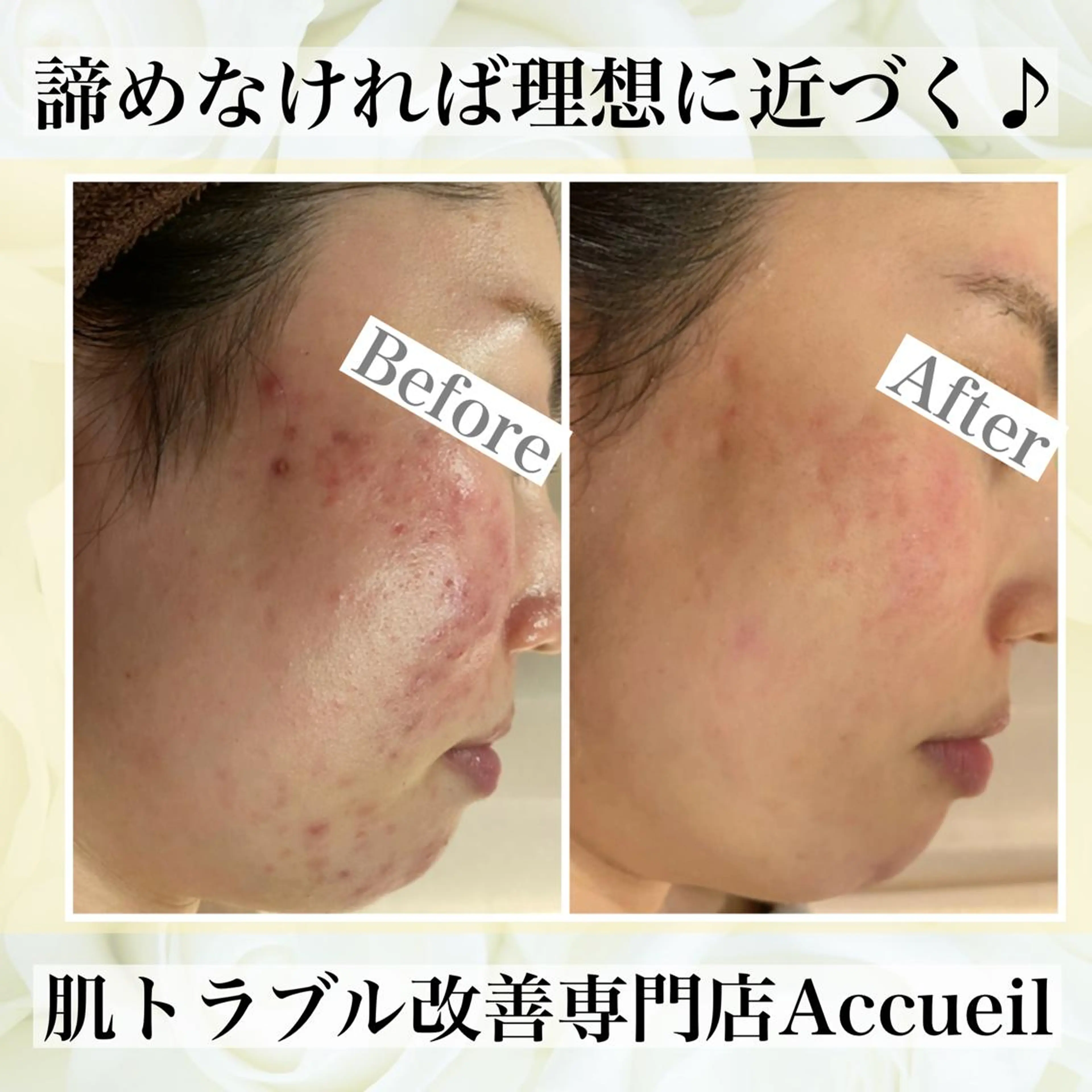 夏までに肌荒れ卒業 するサロン🌻のエステ・リラクイメージ