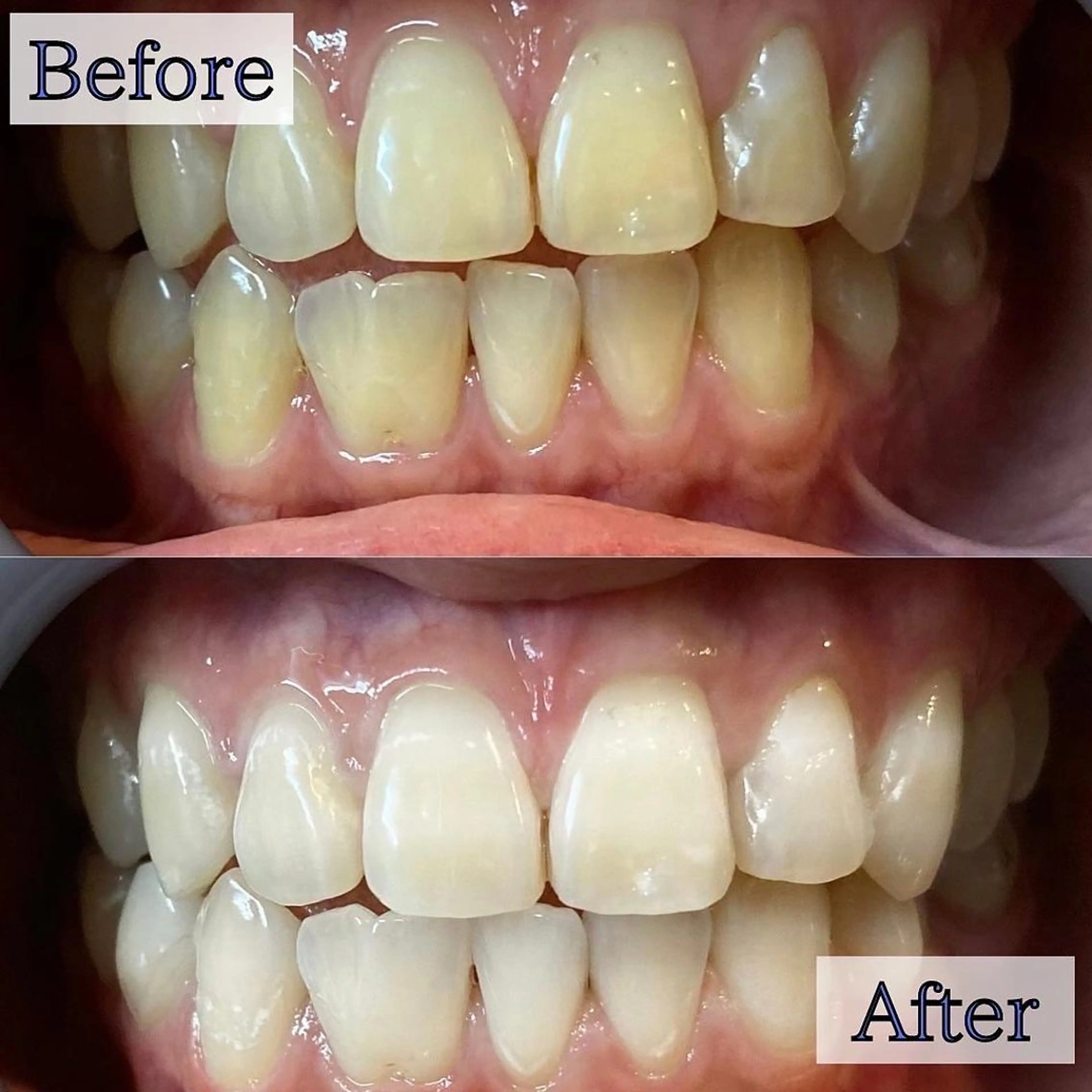 【💜より効果を実感したい方へ💜】5分照射×4回✨効果&速さ⭕️最先端のハイパワーセルフホワイトニング🦷✨の写真