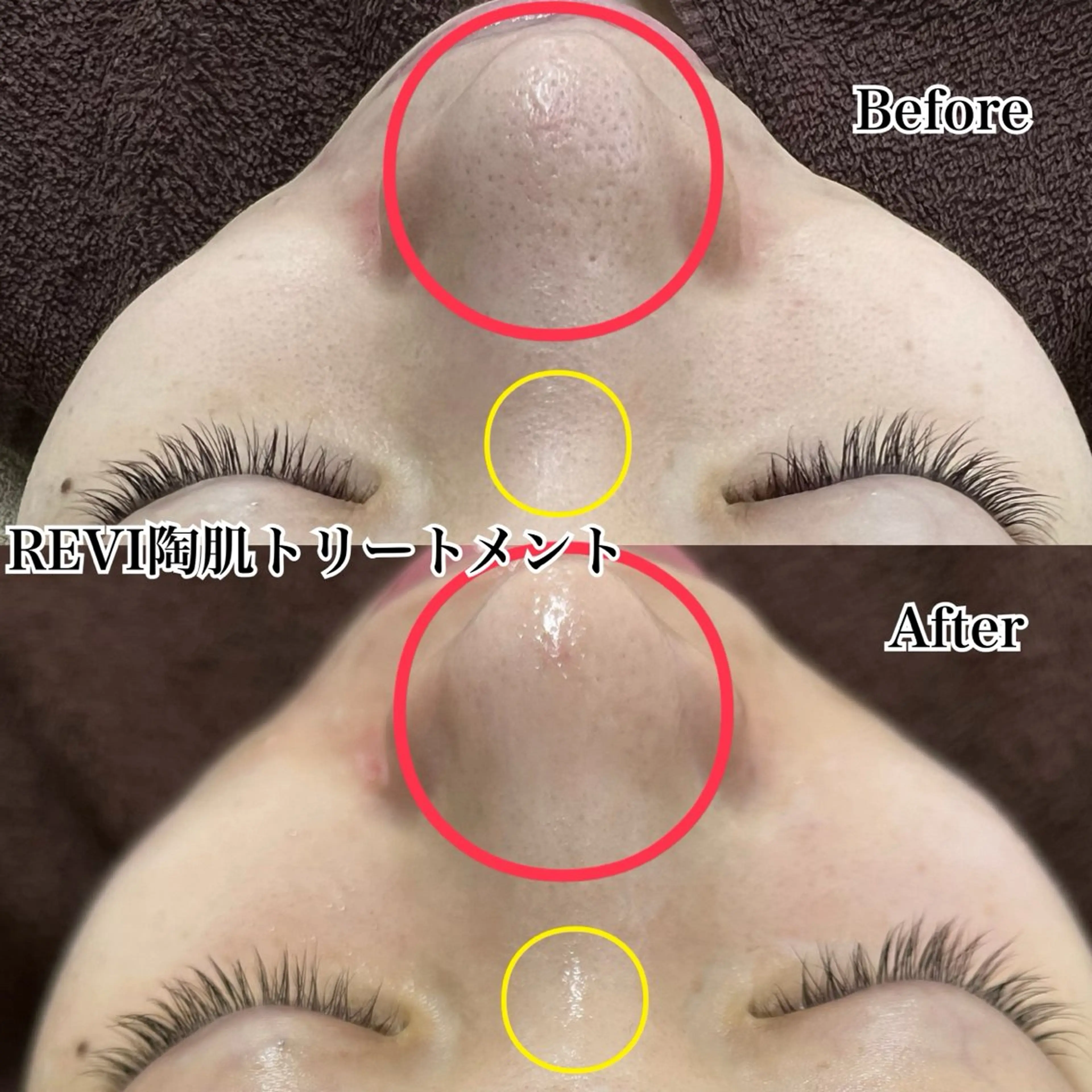 【最強美肌】REVI陶肌トリートメント＋生酵素1ｇの写真