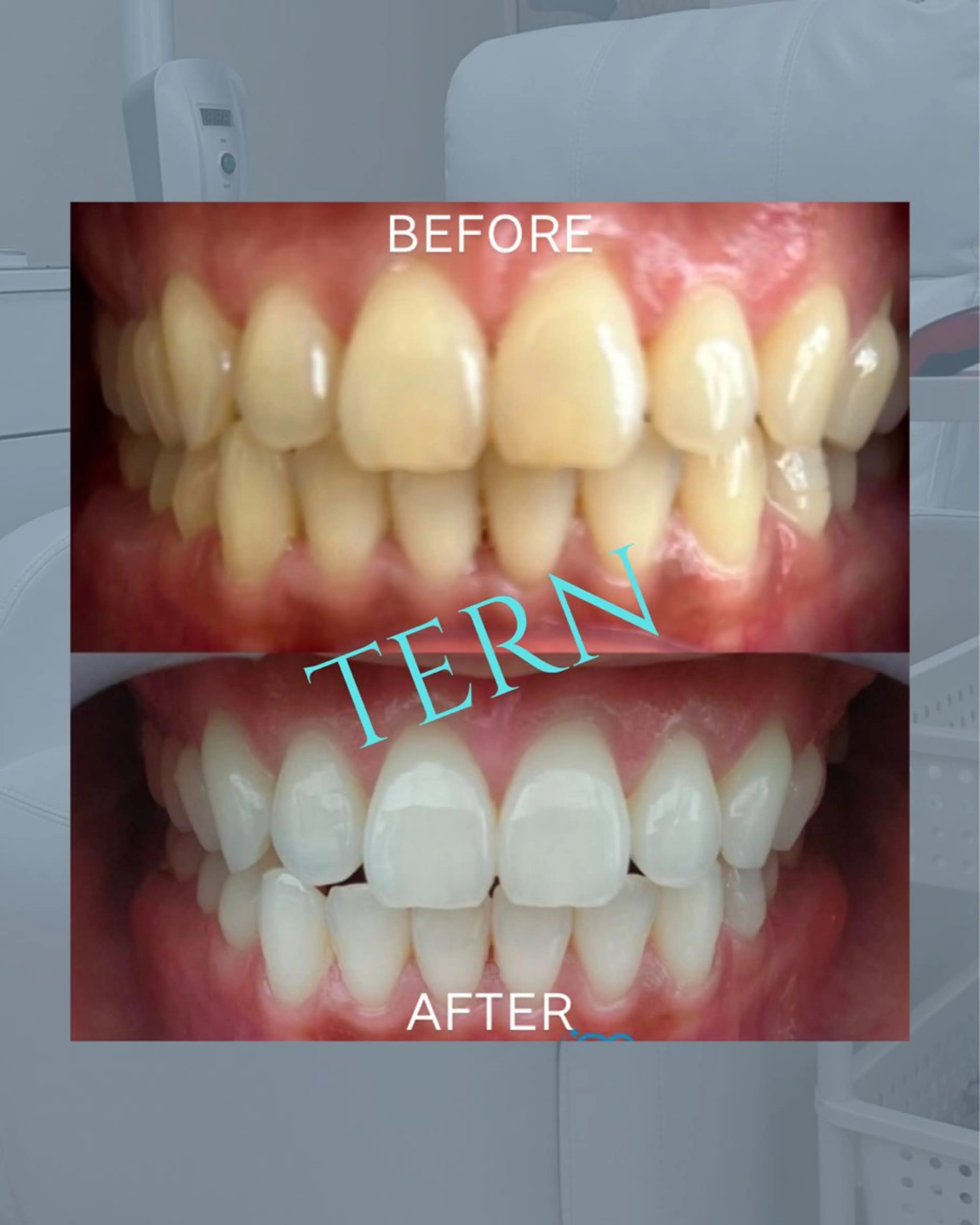 歯のセルフホワイトニング5分2照射の写真
