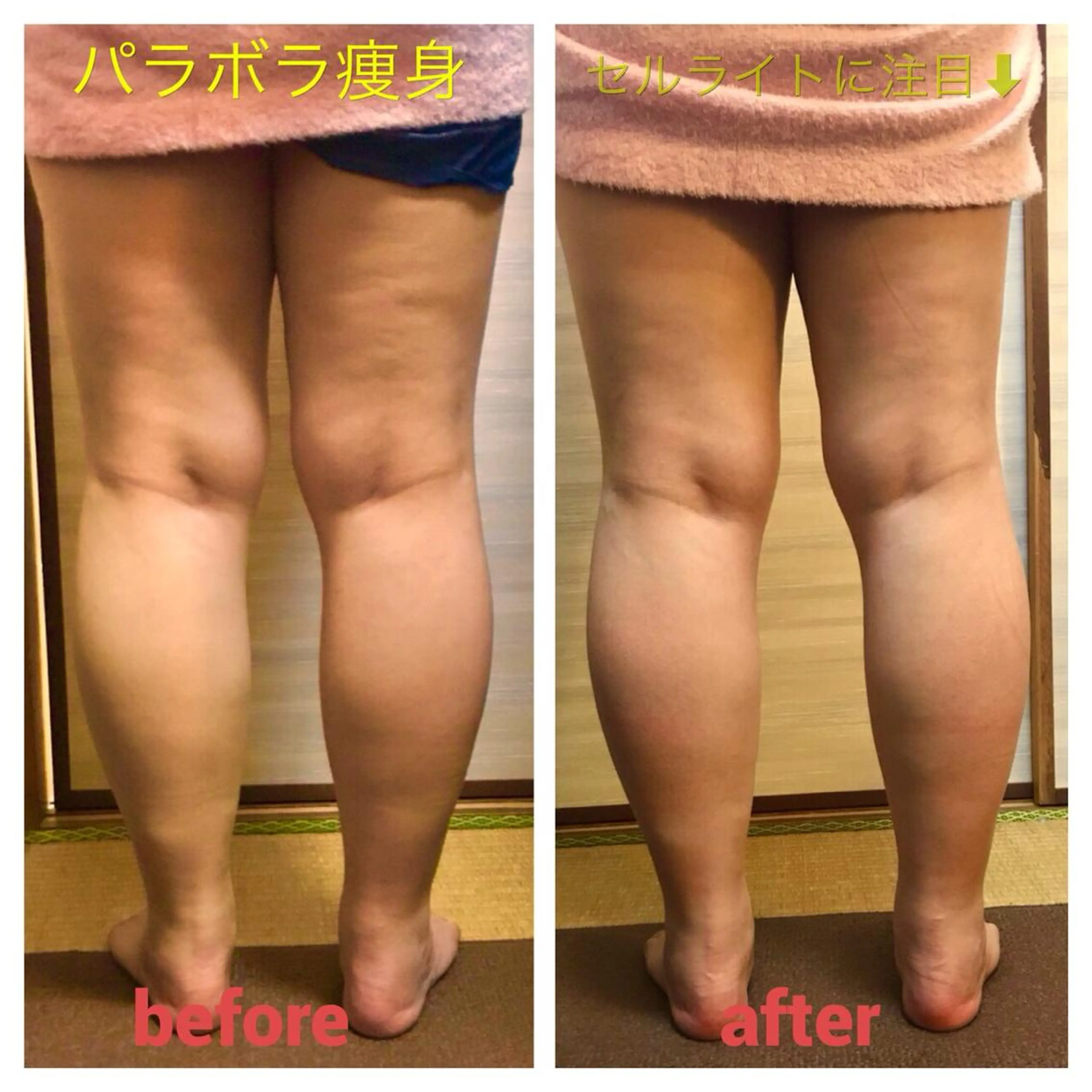 パラボラ痩身(両脚)の写真