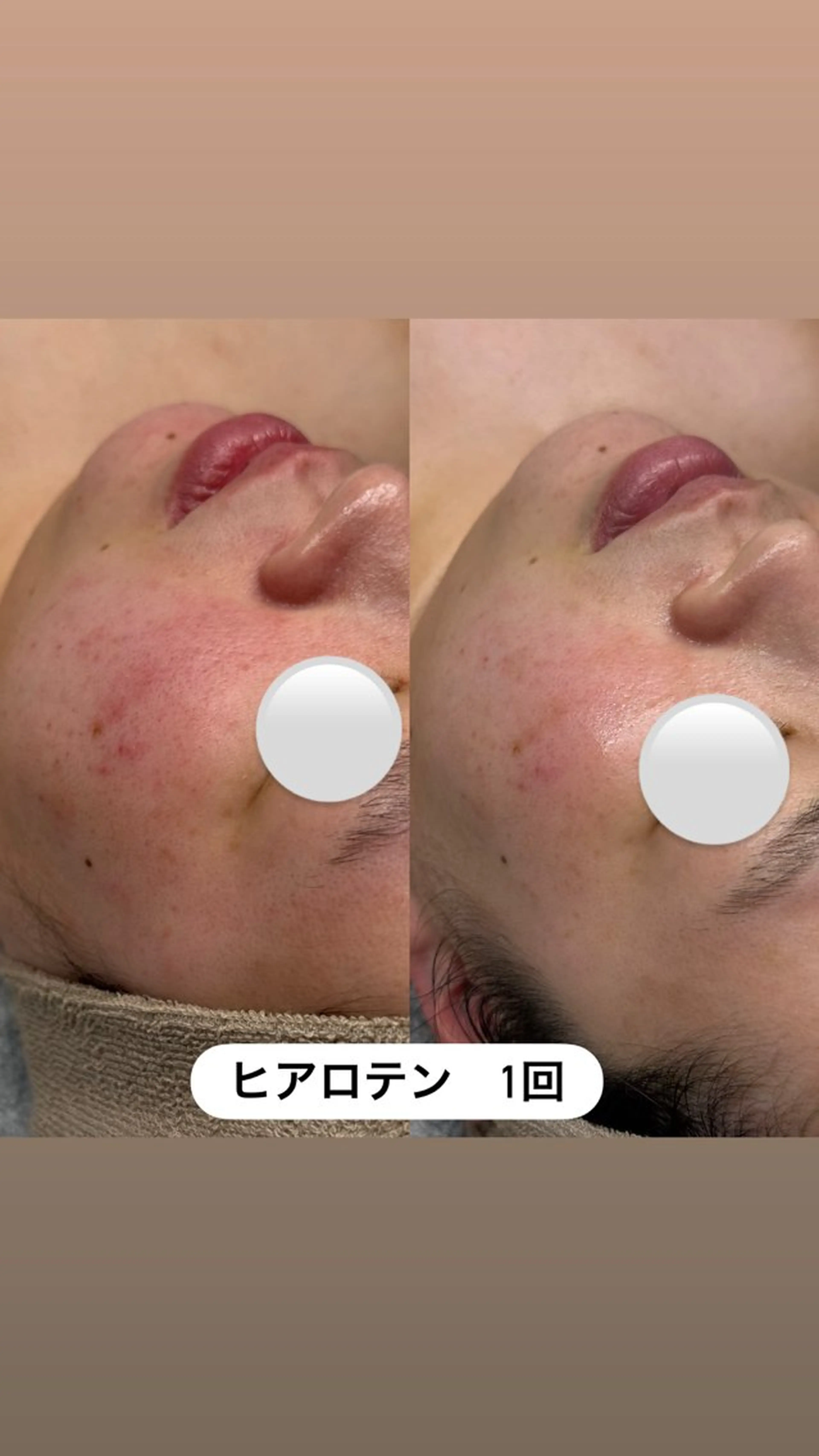 お日にち限定7700円均一✨どのメニューをお選びいただきても7700円で受けられます!敏感、ニキビ、毛穴、エイジングに!の写真