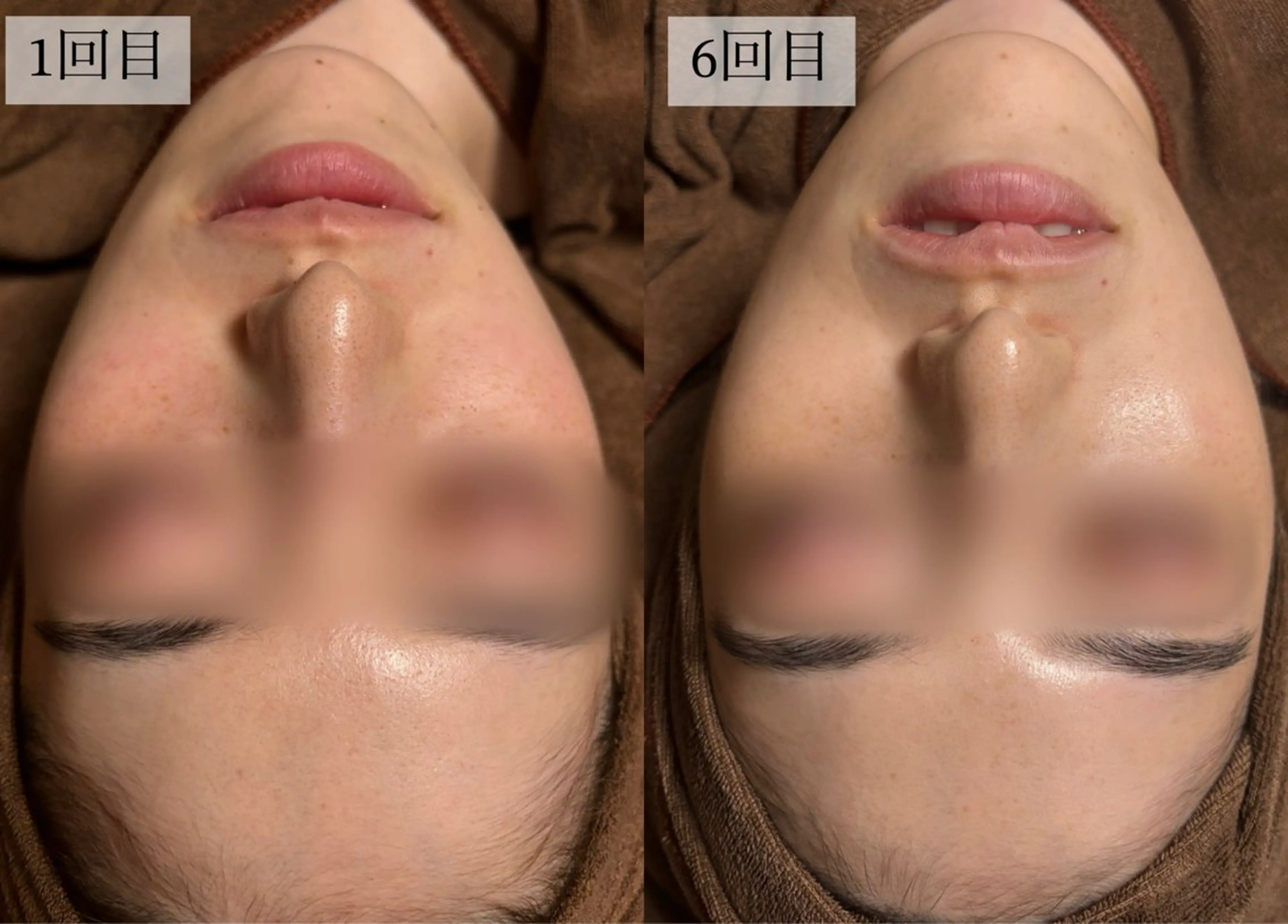 エステ HINANO矢場町店【ヒナノ】所属・脱毛/肌改善🌿 HINANO 村田のエステ・リラクイメージ