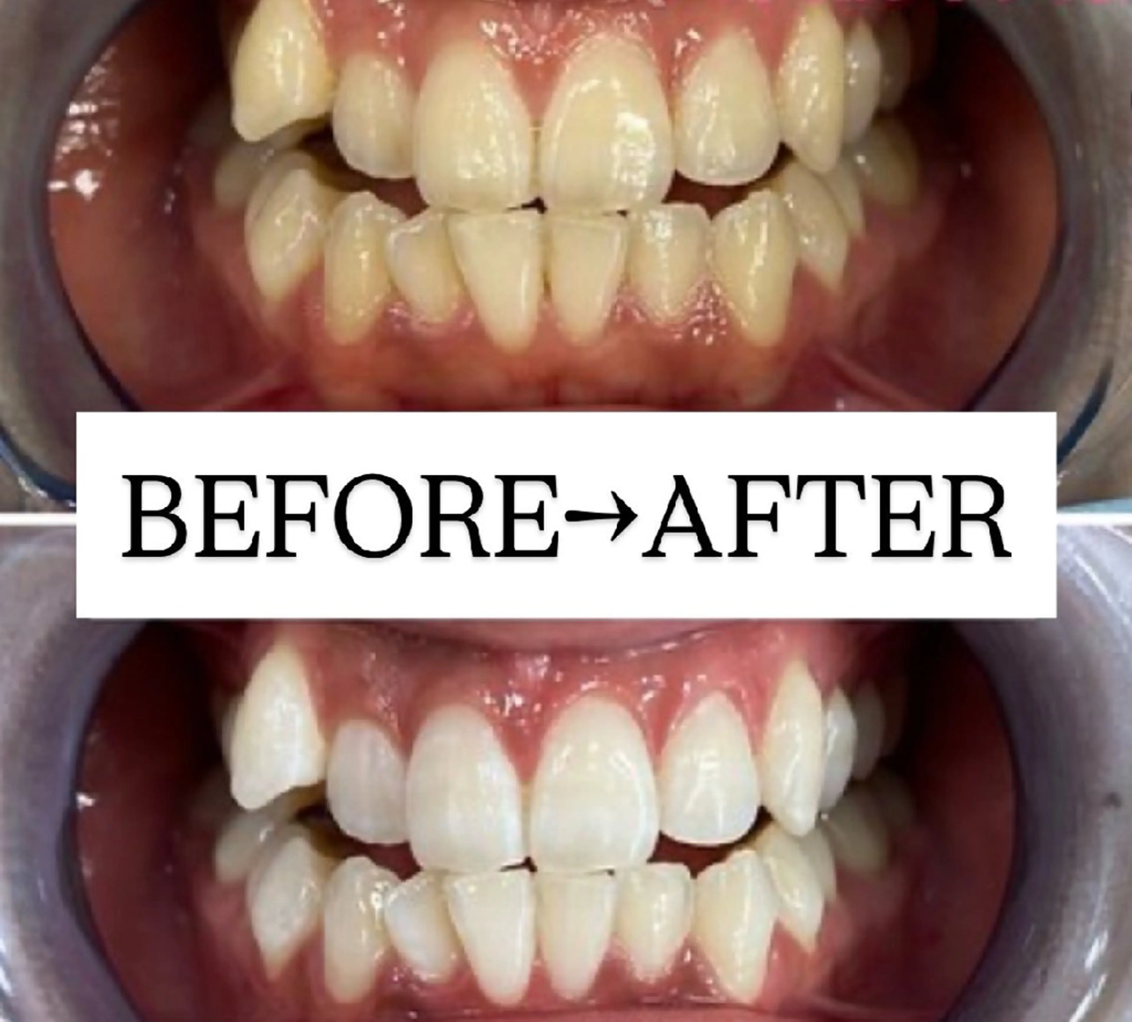 【まずはご相談されたい方★】セルフホワイトニング無料カウンセリング¥0の写真