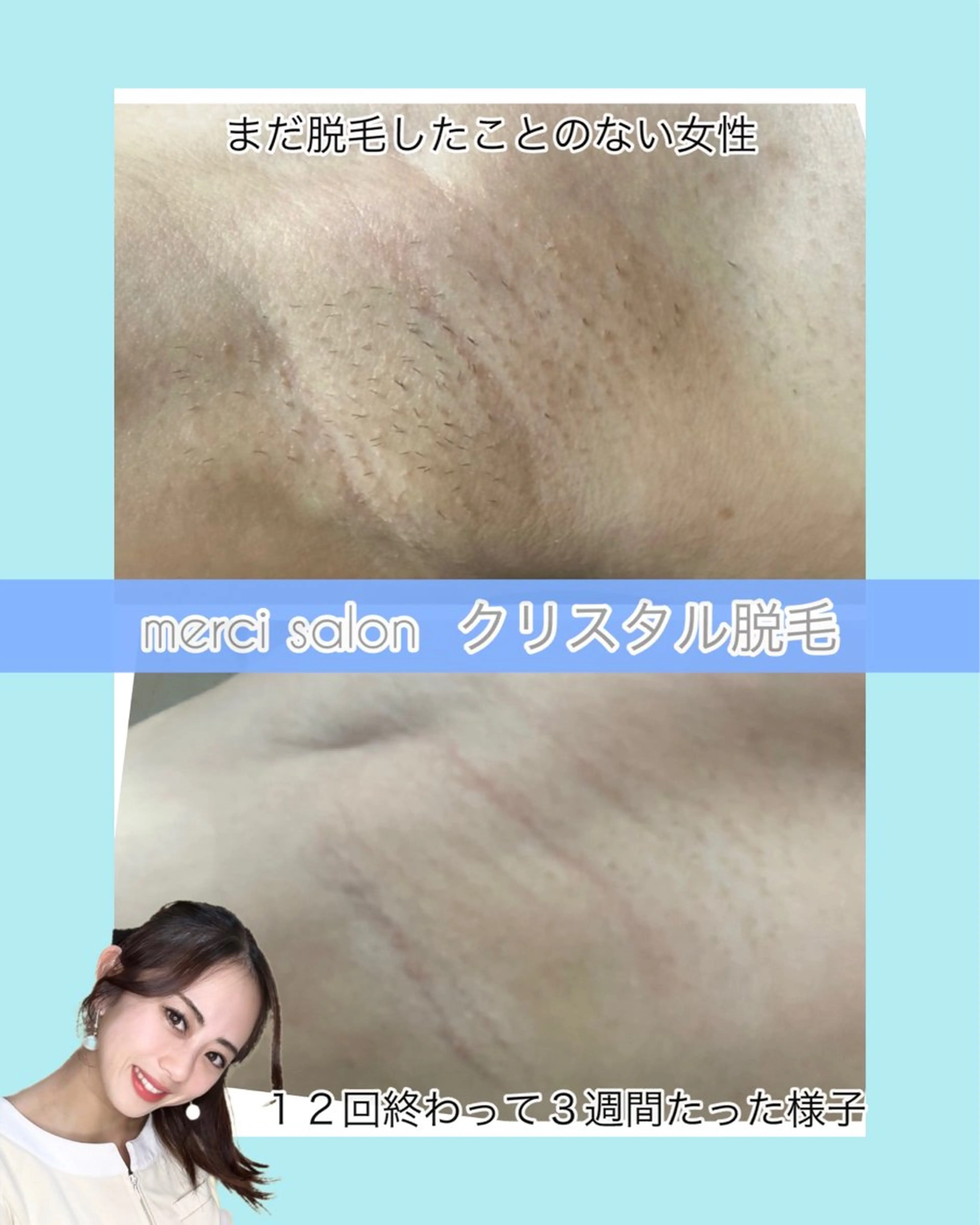 💎冬季限定💎セルフ脱毛15分の写真