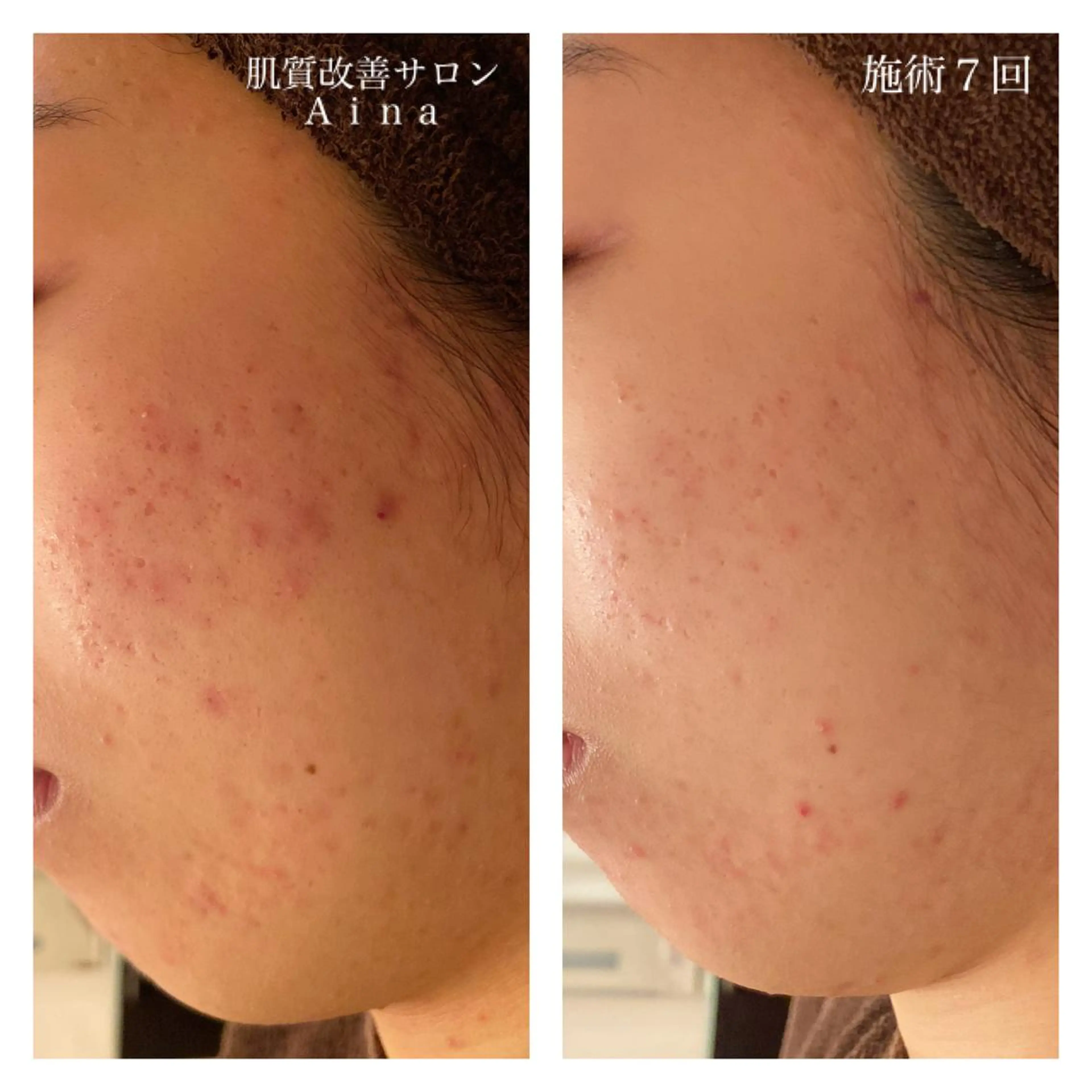 ロング カラー パーマ ヘアアレンジ メンズ キッズ ネイル マツエク・マツパ 赤色 エステ リラク ニキビ跡専門サロン Ainaのエステ・リラクイメージ