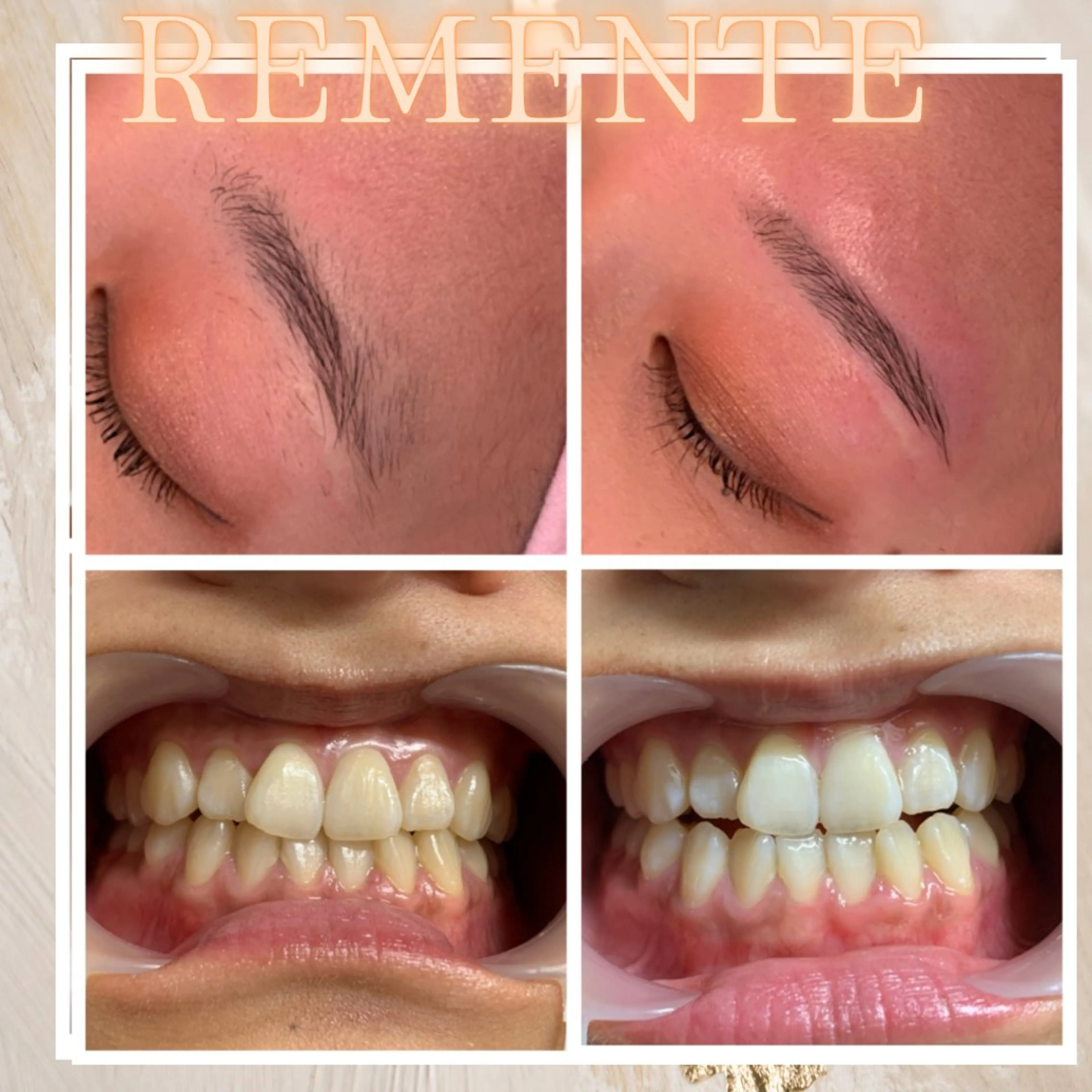 【今月限定】2点同時施術可能🌹  プレミアムホワイトニング+眉毛 Wax脱毛🌹　歯科医師監修の液剤の写真