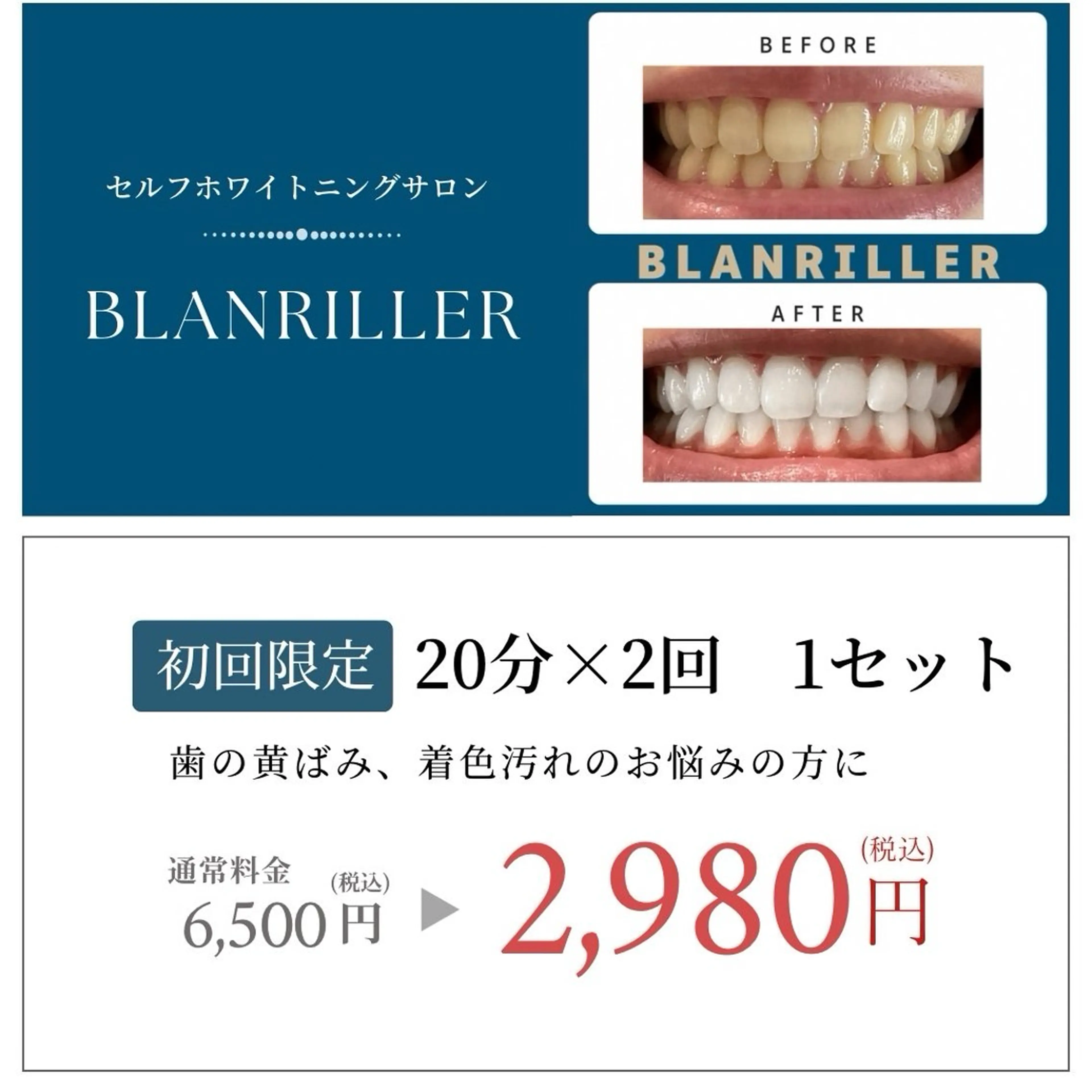 ❤期間限定特別セール❤限定10名様✨【40分照射】高濃度セルフホワイトニング6500円→2980円‼効果実感の声多数◎の写真