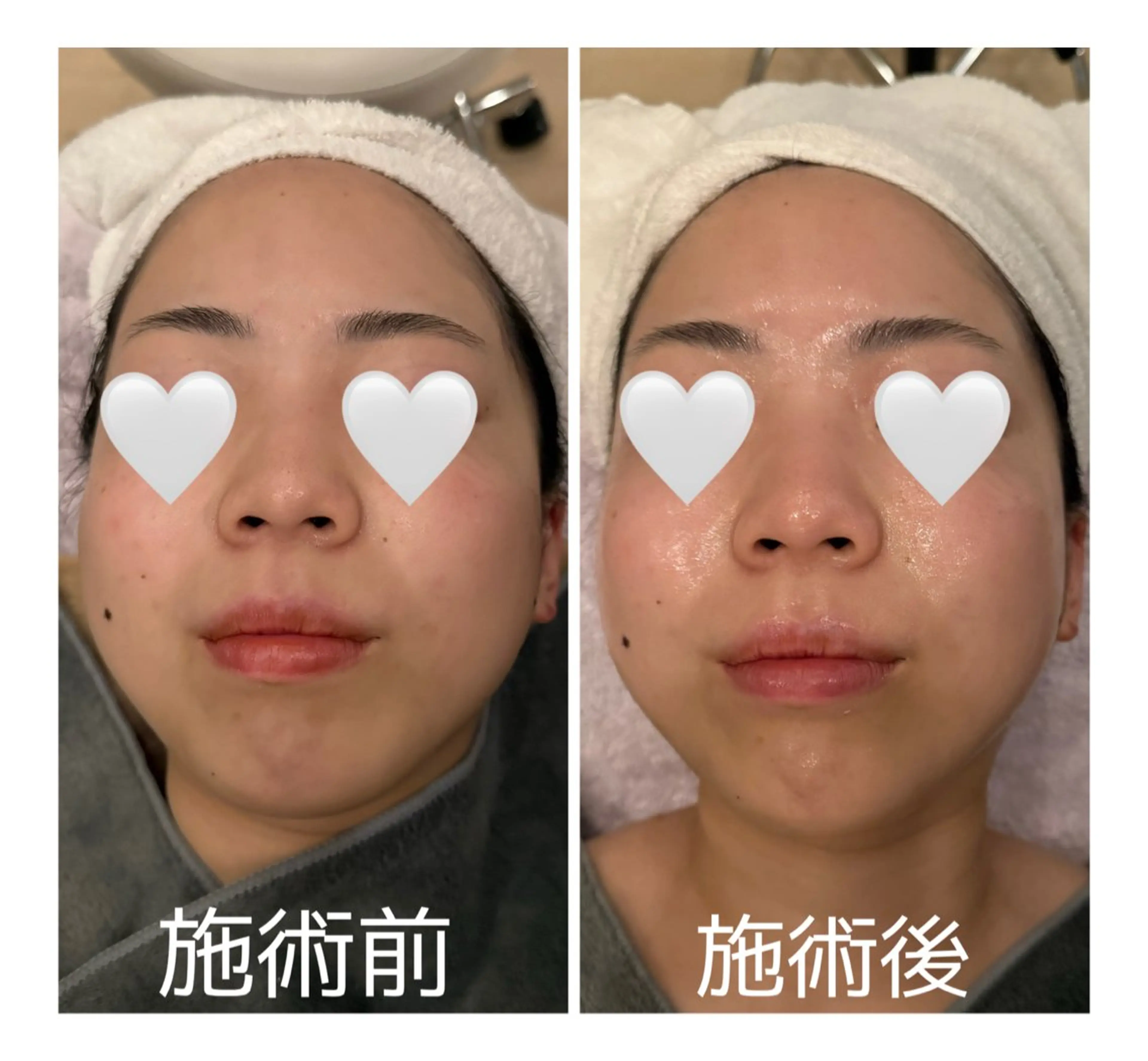 💜劇的ビフォーアフター💜アドバンスコース50分➕ラインズLRパック💆‍♀️の写真