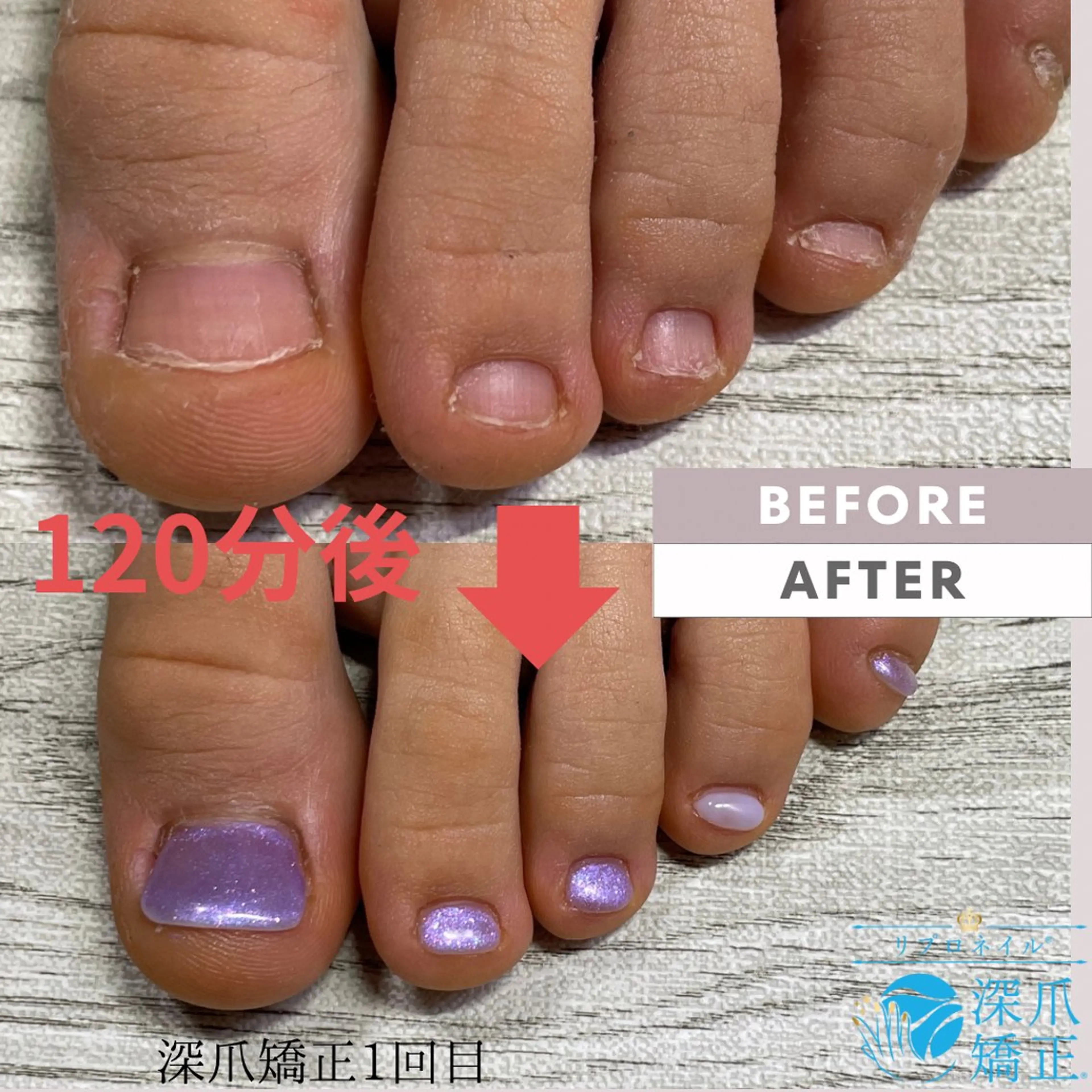 【オフなし】深爪矯正50％オフの写真