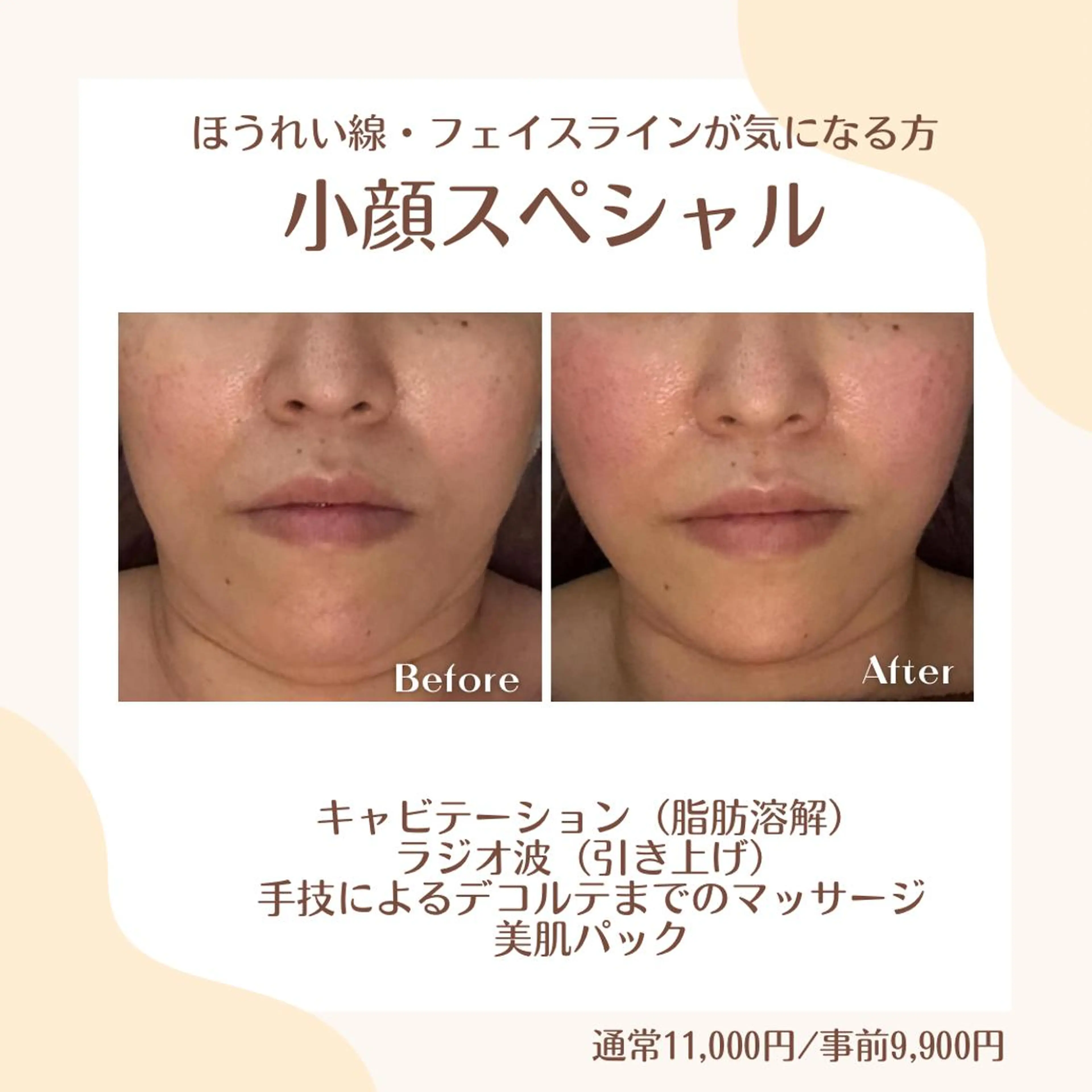 小顔スペシャル【当店ご新規限定】当日OK/すぐ予約OK/お支払いは現金のみの写真