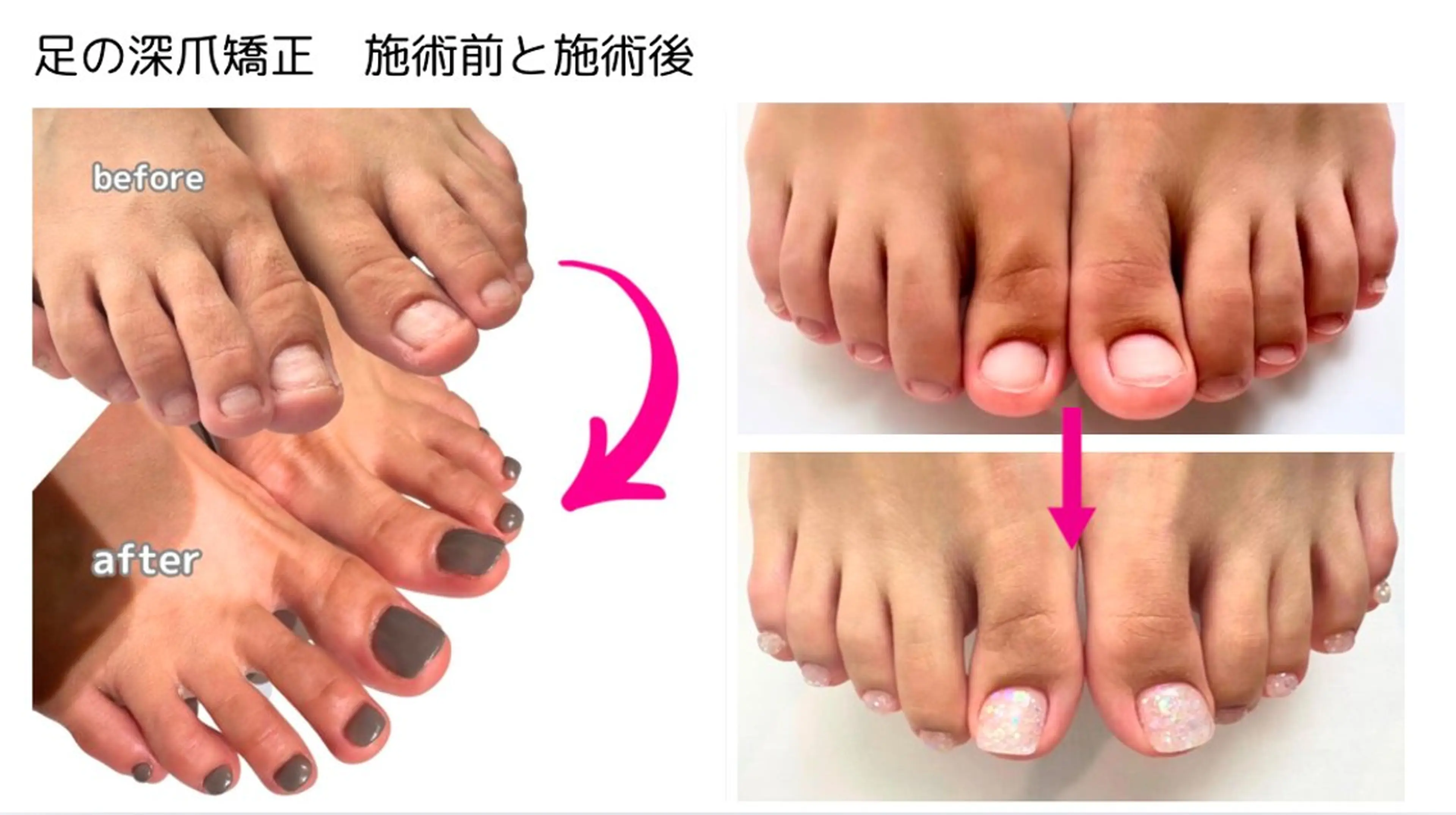 ネイル フットネイル 深爪矯正専門店ネイルサロンKUU所属・深爪矯正専門店 ネイルサロンKUUのネイルデザイン