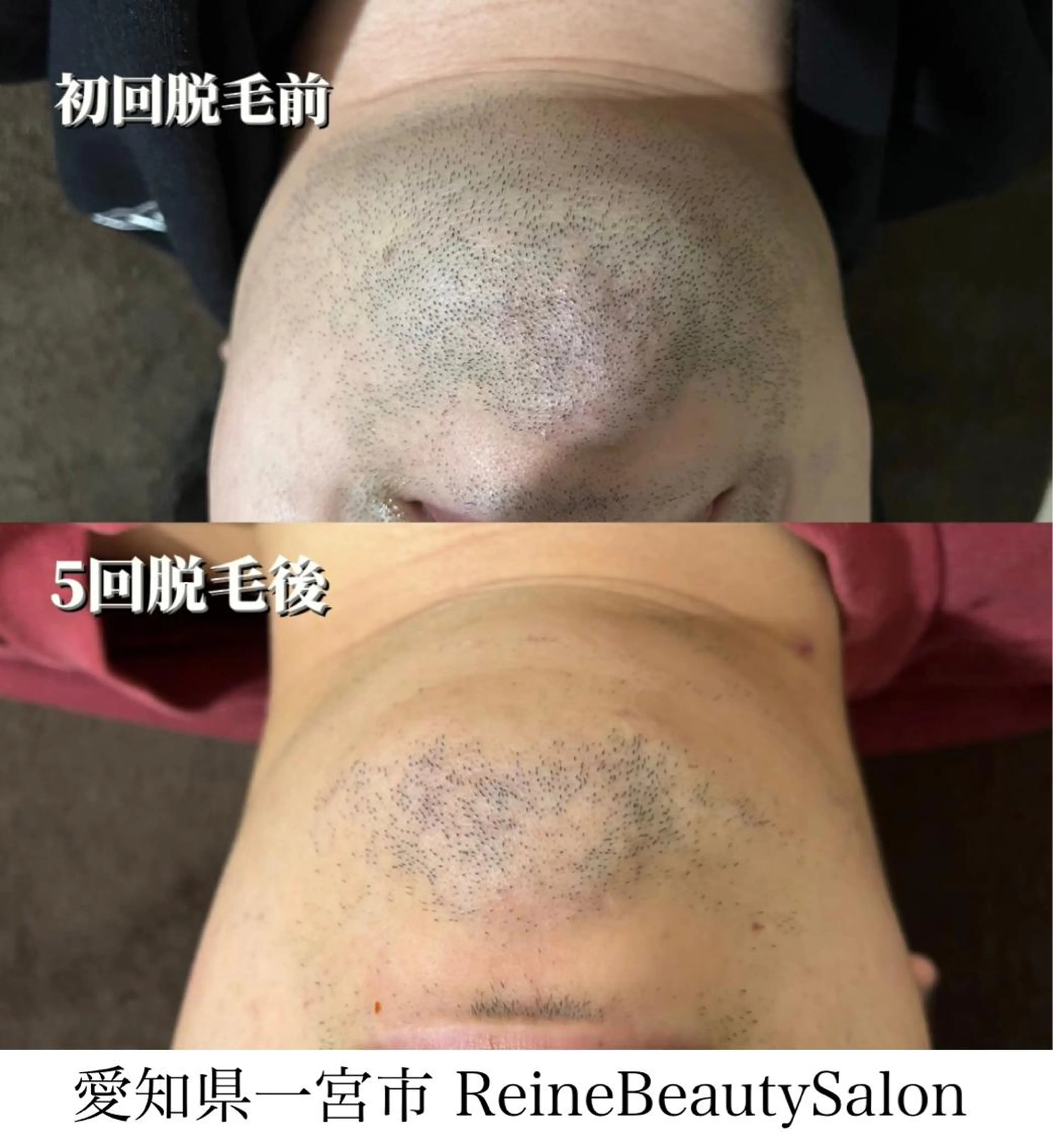 脱毛 Reine BeautySalon所属・毛穴/シミ肝斑/脱毛 横山梨里のエステ・リラクイメージ