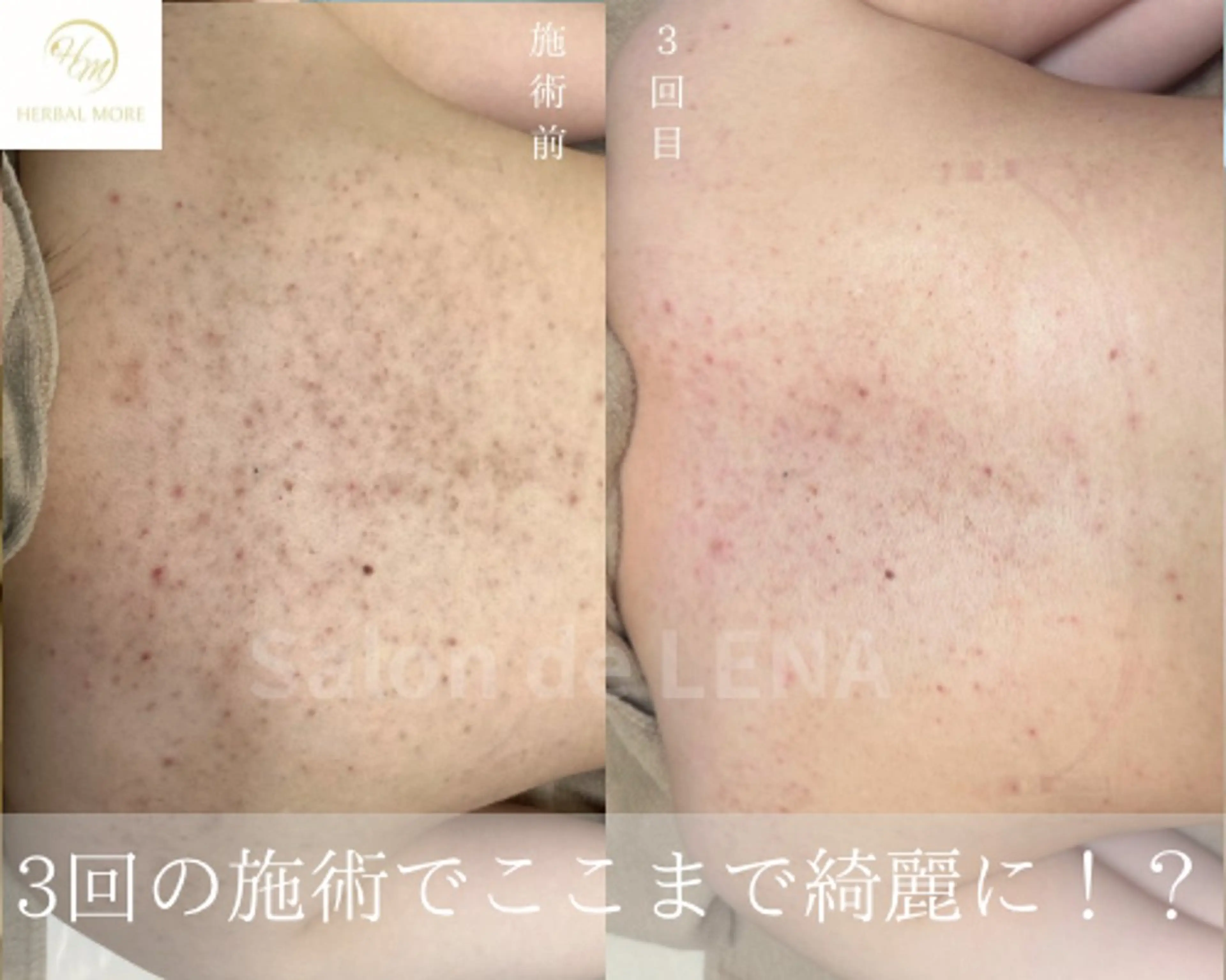 サロンドレナ名駅店所属・ハーブピーリング専門 サロンドレナ平岡のエステ・リラクイメージ