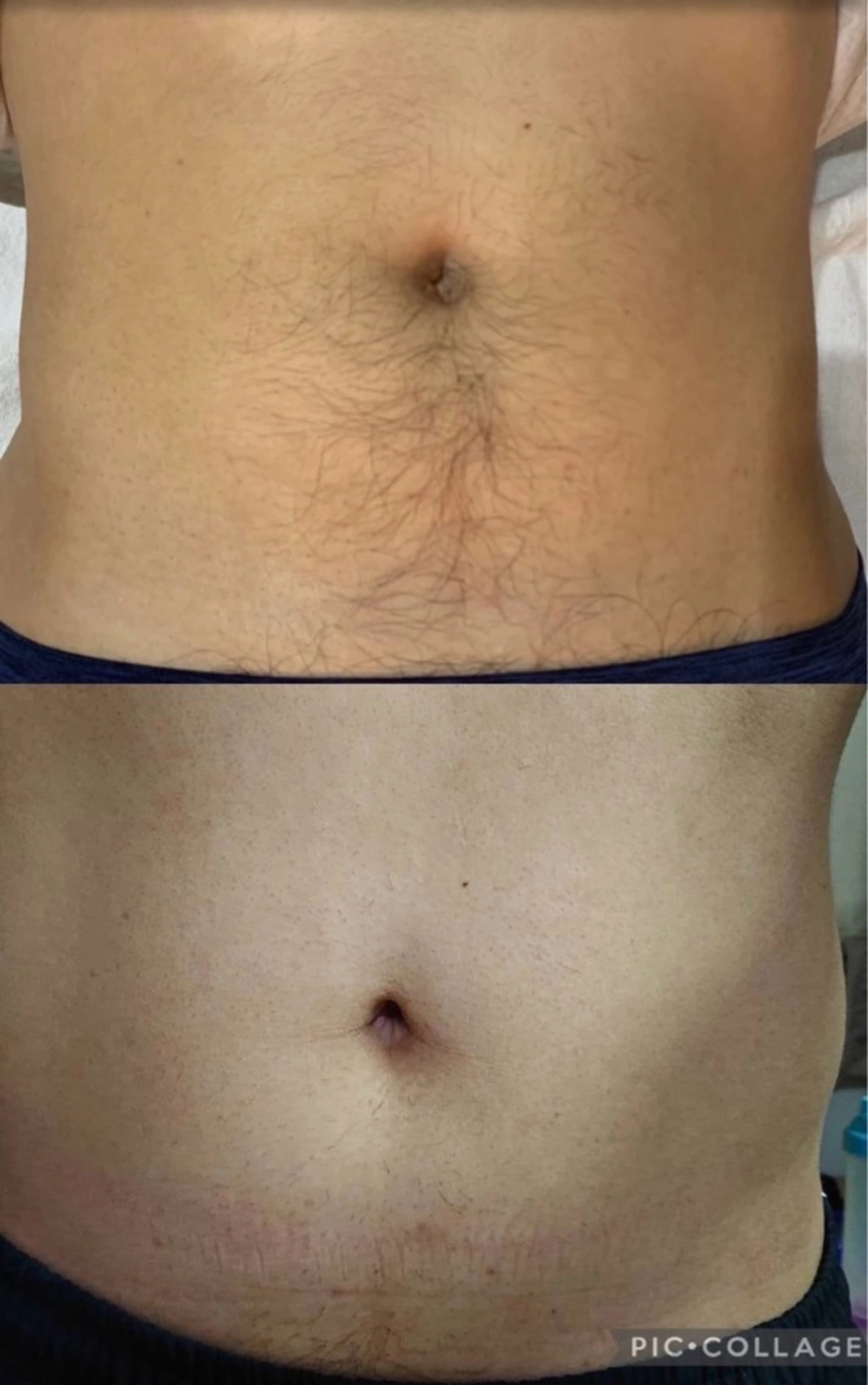 メンズ全身脱毛(顔、VIO込み)の写真