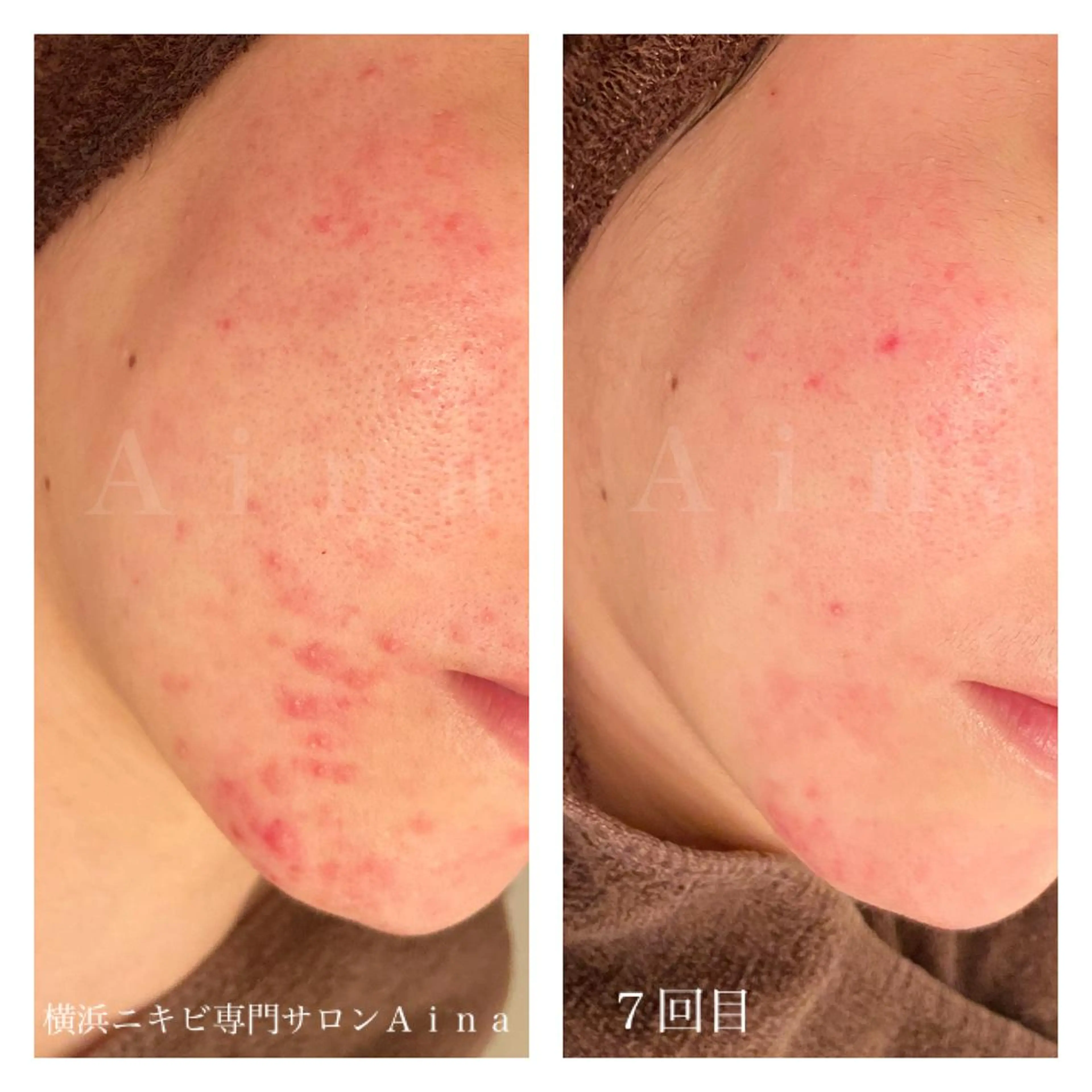 ミディアム カラー パーマ ヘアアレンジ メンズ キッズ ネイル マツエク・マツパ クリアネイル 赤色 エステ リラク ニキビ跡専門サロン Ａｉｎａのエステ・リラクイメージ