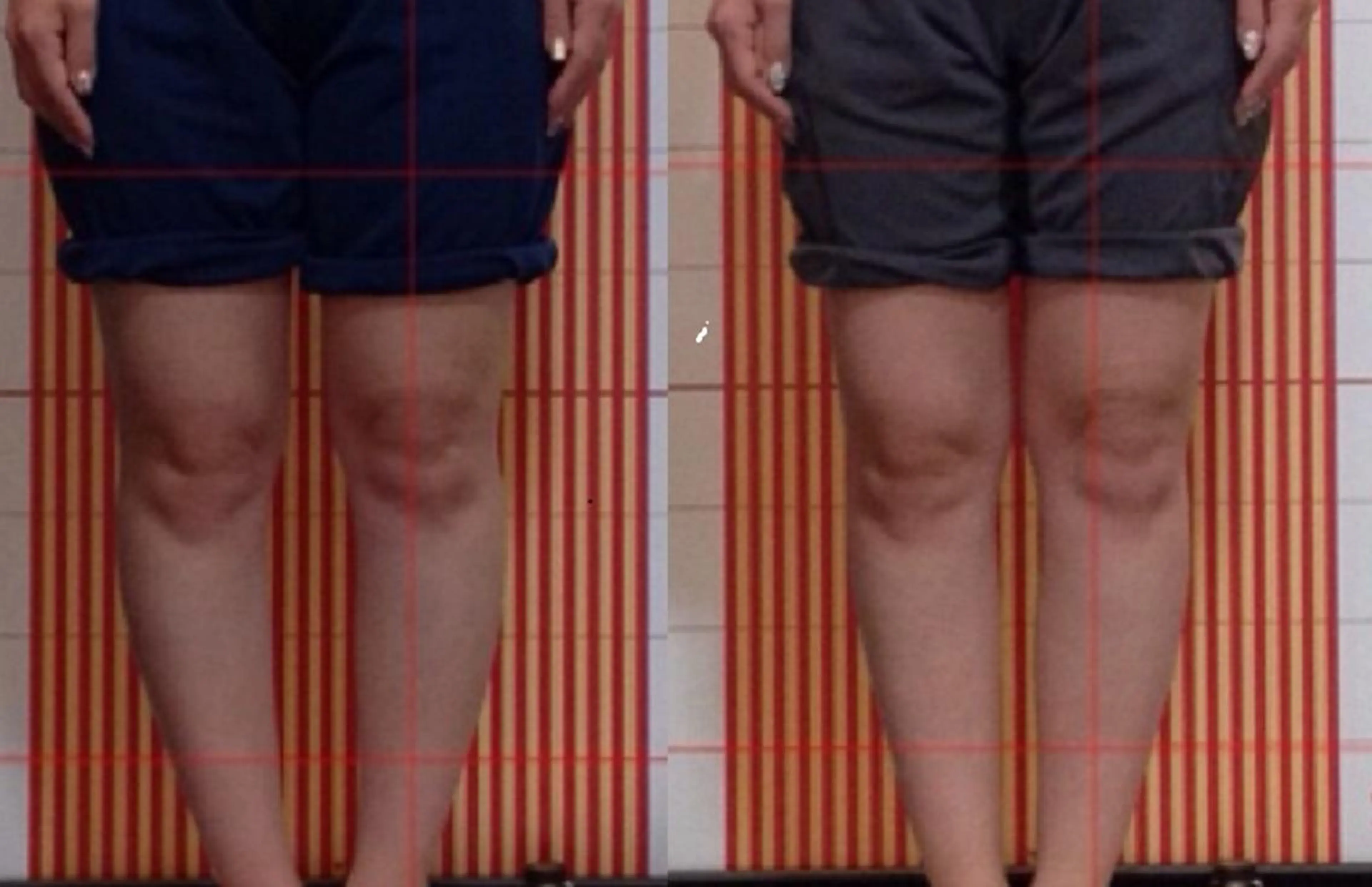 初回限定　￥4980 美脚、O脚、X脚、姿勢改善、骨盤矯正コース70分　 の写真