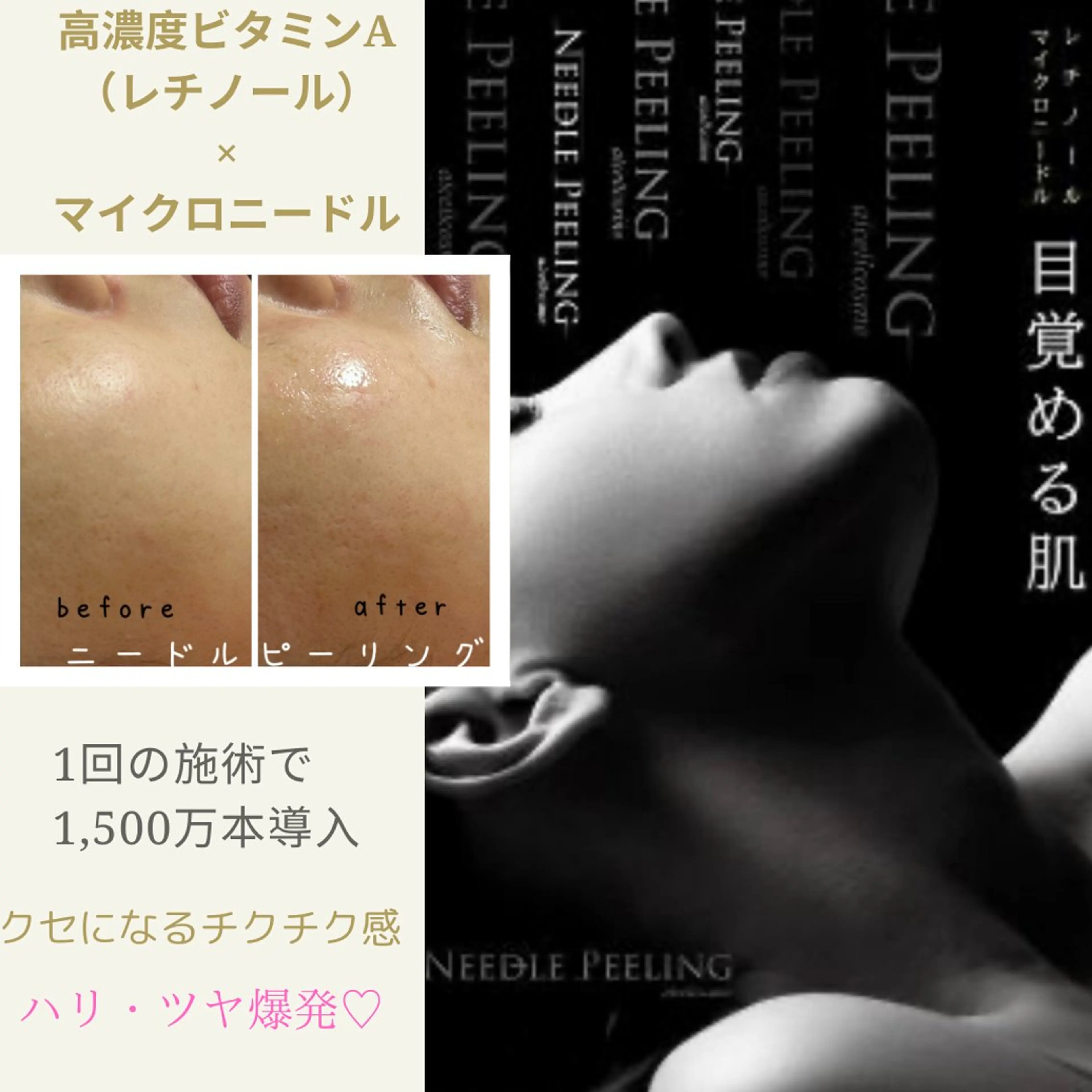 【毛穴】【毛穴開き】【小顔】【リフト】【くすみ】【吹き出物】マイクロニードル導入エステ🌟艶肌への写真