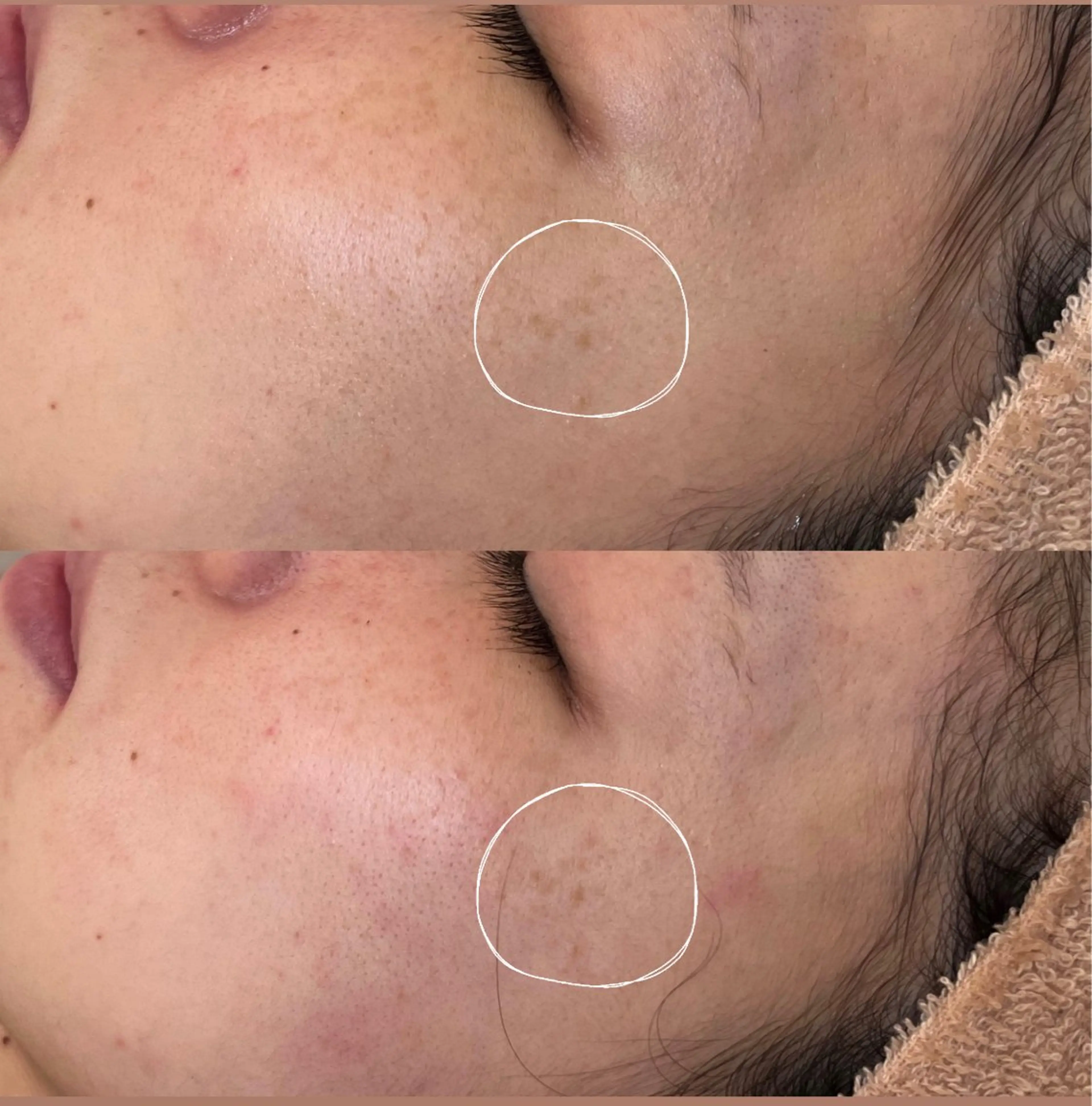 毛穴ケア/毛穴診断/ 毛穴洗浄〔心斎橋〕のエステ・リラクイメージ