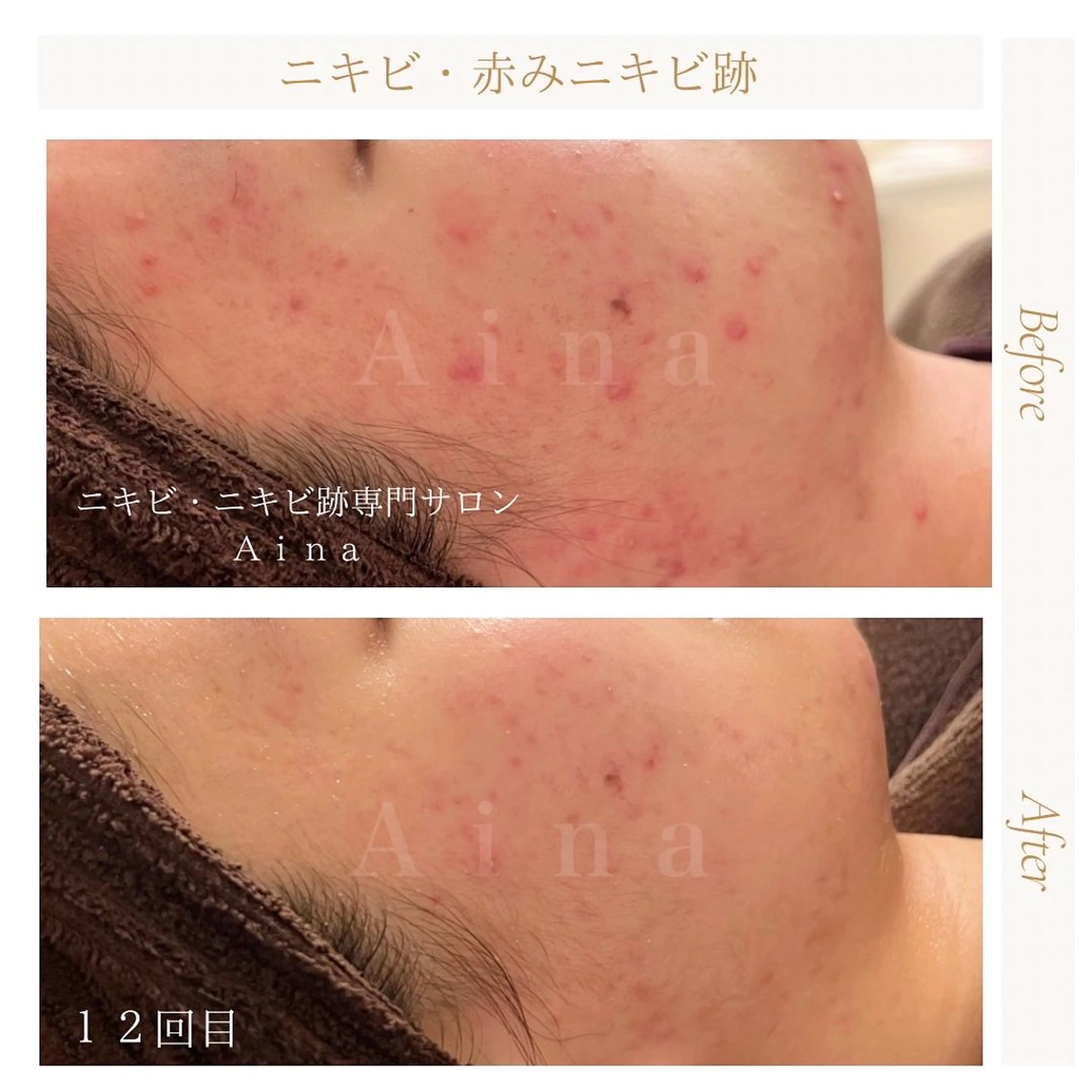 セミロング パーマ ヘアアレンジ メンズ キッズ ネイル マツエク・マツパ アイブロウ 赤色 エステ リラク ニキビ跡専門サロン Ainaのエステ・リラクイメージ