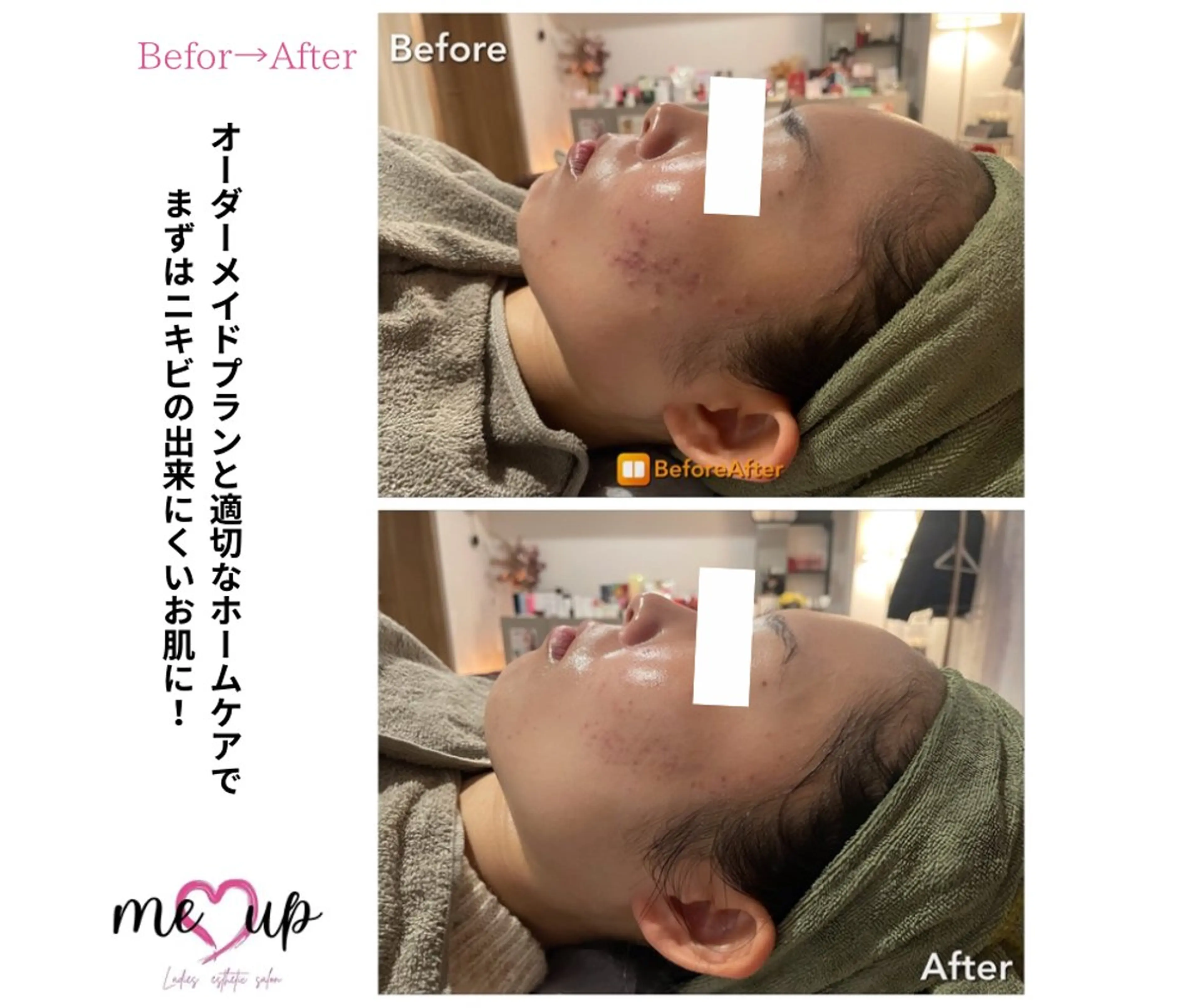 エステ Meupニキビ専門店 背中/ハーブ/肌管理のその他イメージ