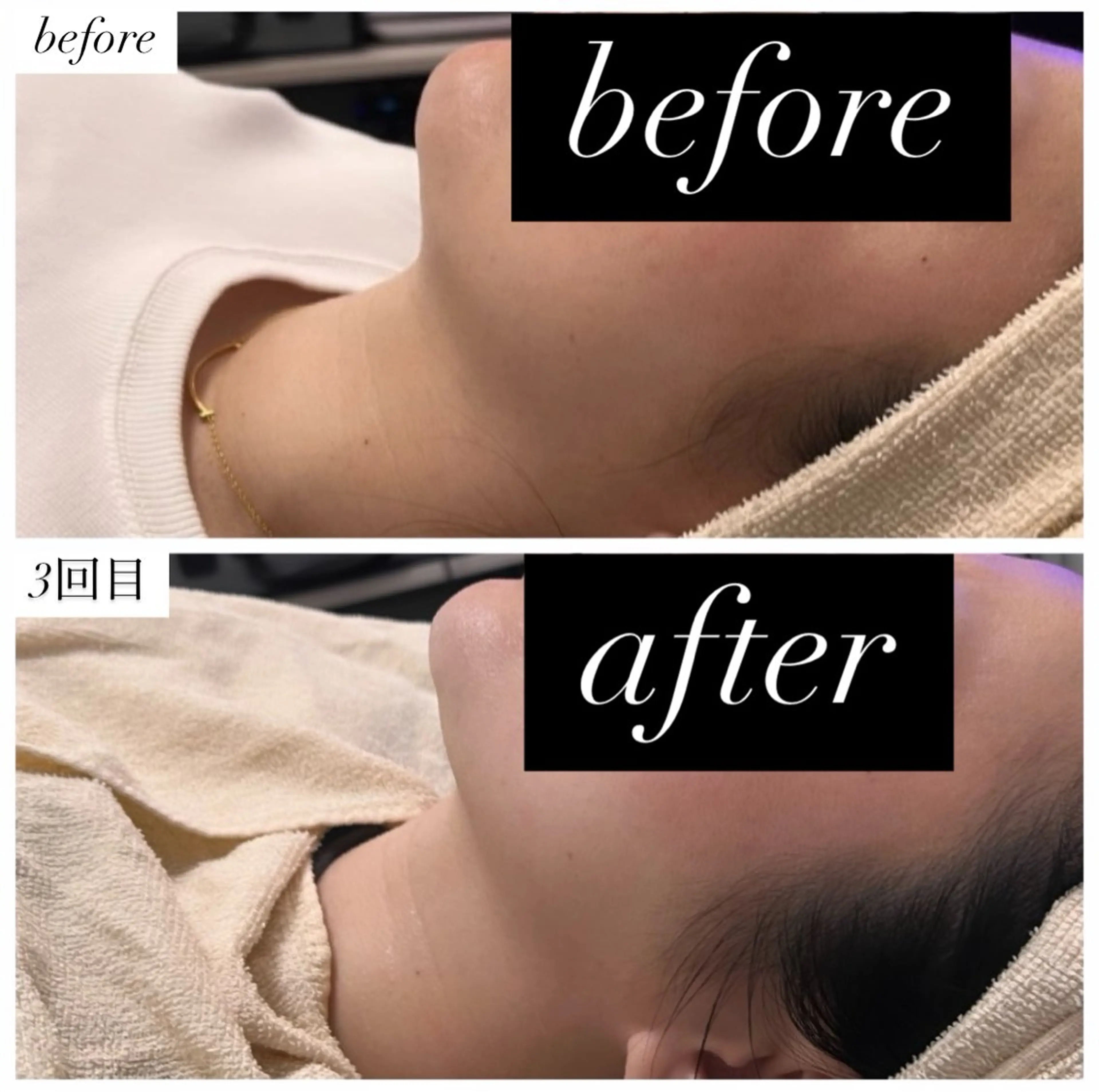 最新韓国美容二重顎リバウンドなし◎の写真