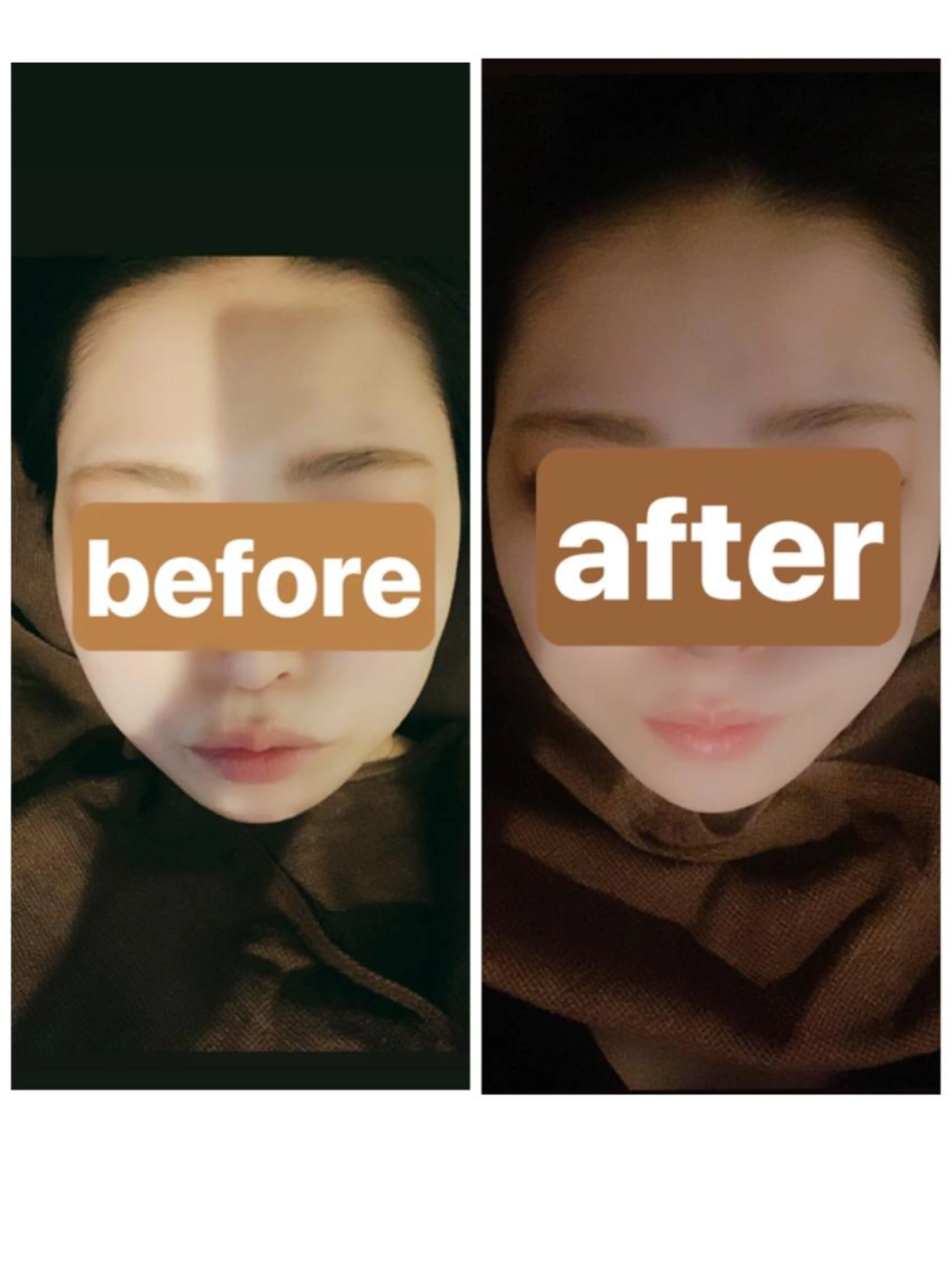 小顔エステ【たるみが気になる方ほうれい線が気になる方】の写真