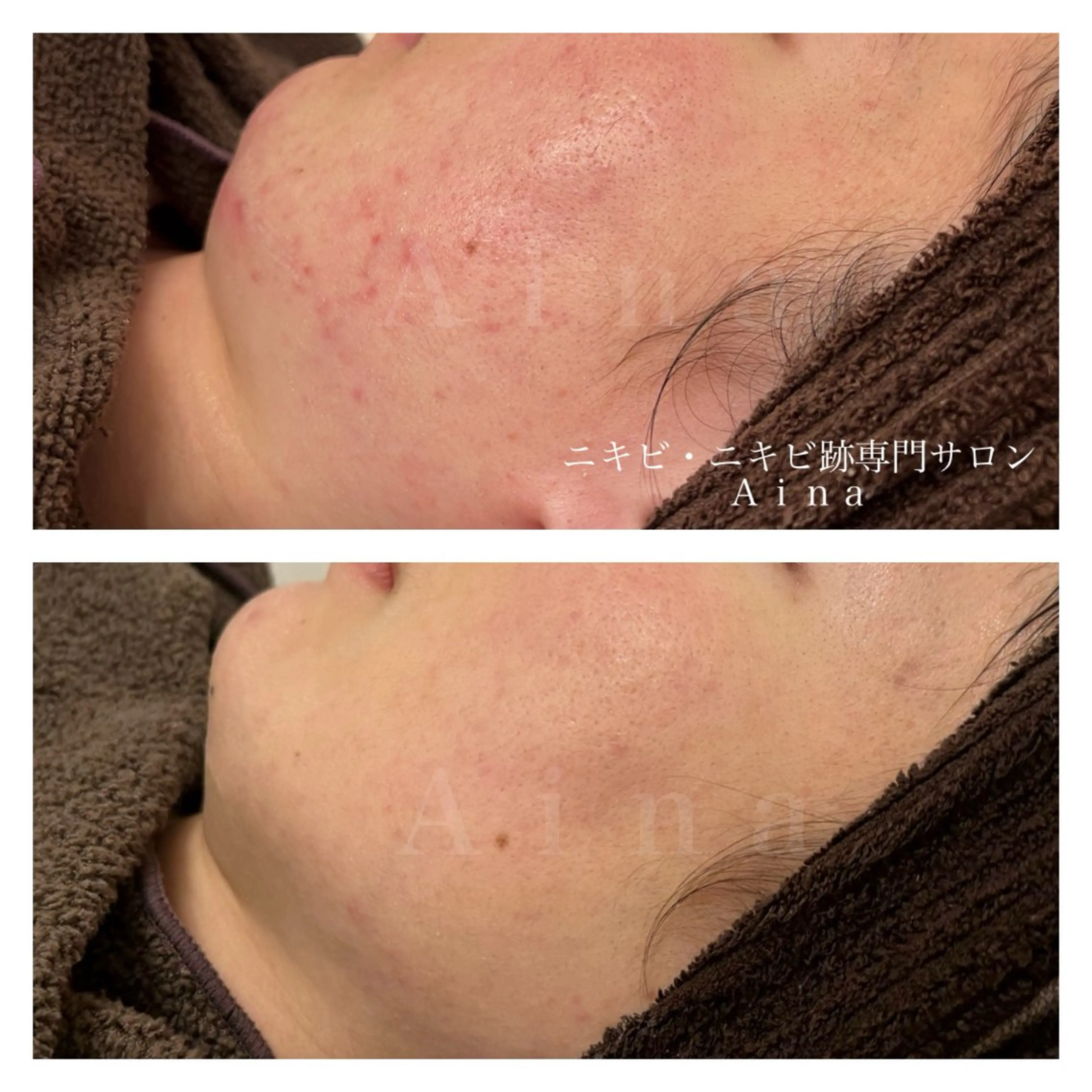 エステ リラク ニキビ跡専門サロン Ａｉｎａのエステ・リラクイメージ