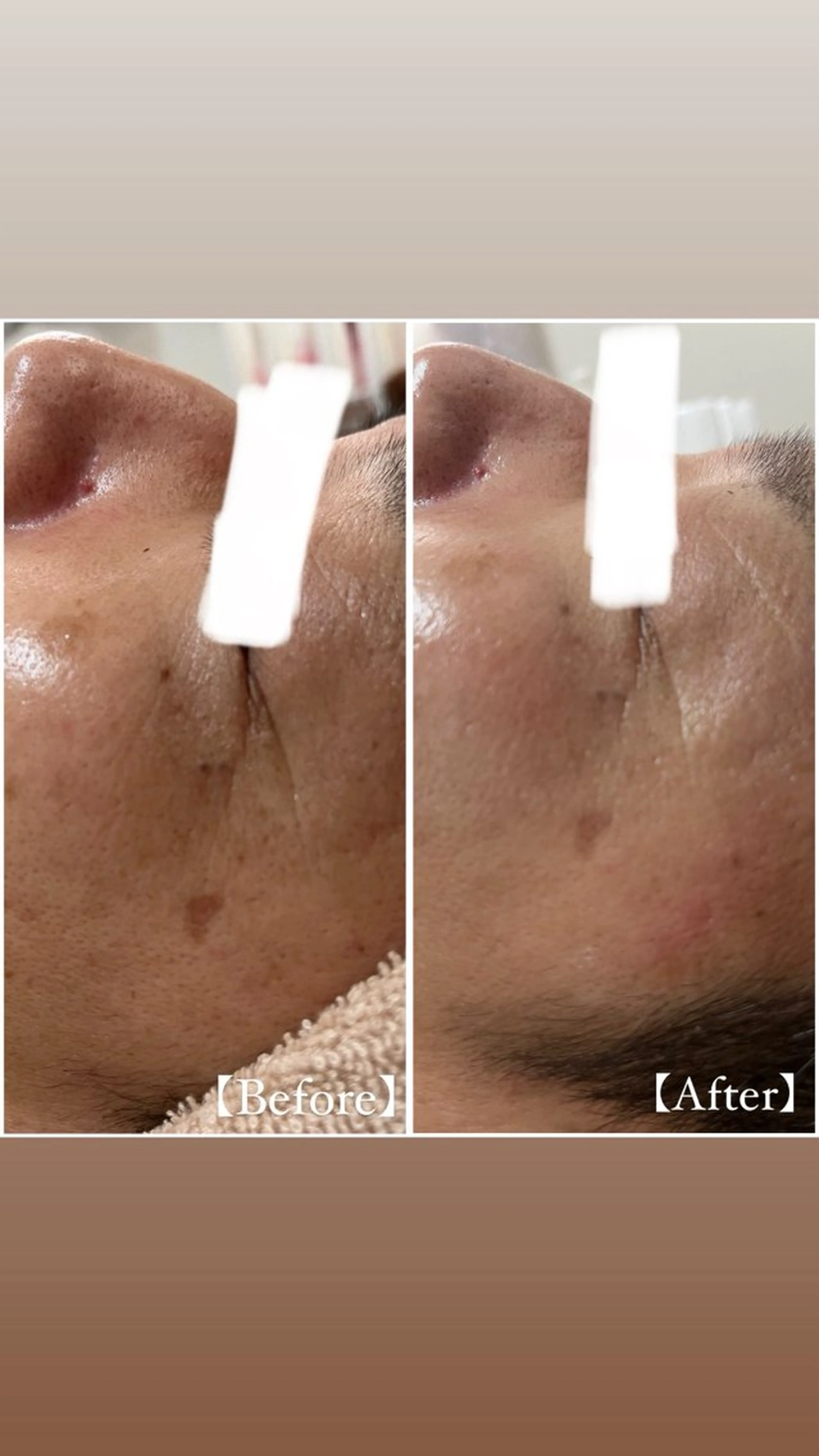 当店人気No.3メニュー✨️【 若化ケア 】 REVIハーブピーリング🌿の写真