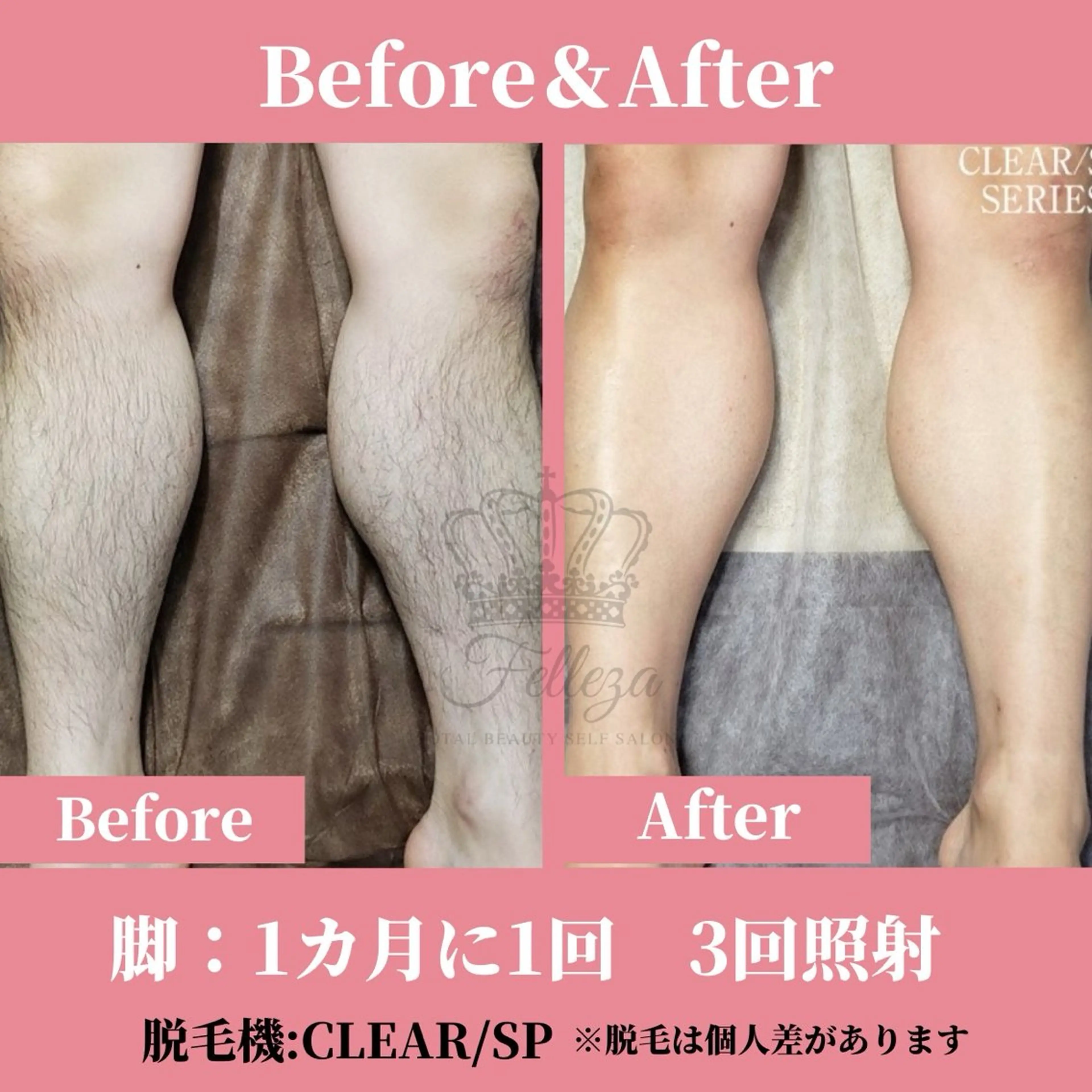 メンズ キッズ 有人型セルフサロン 脱毛／痩身／美顔のその他イメージ