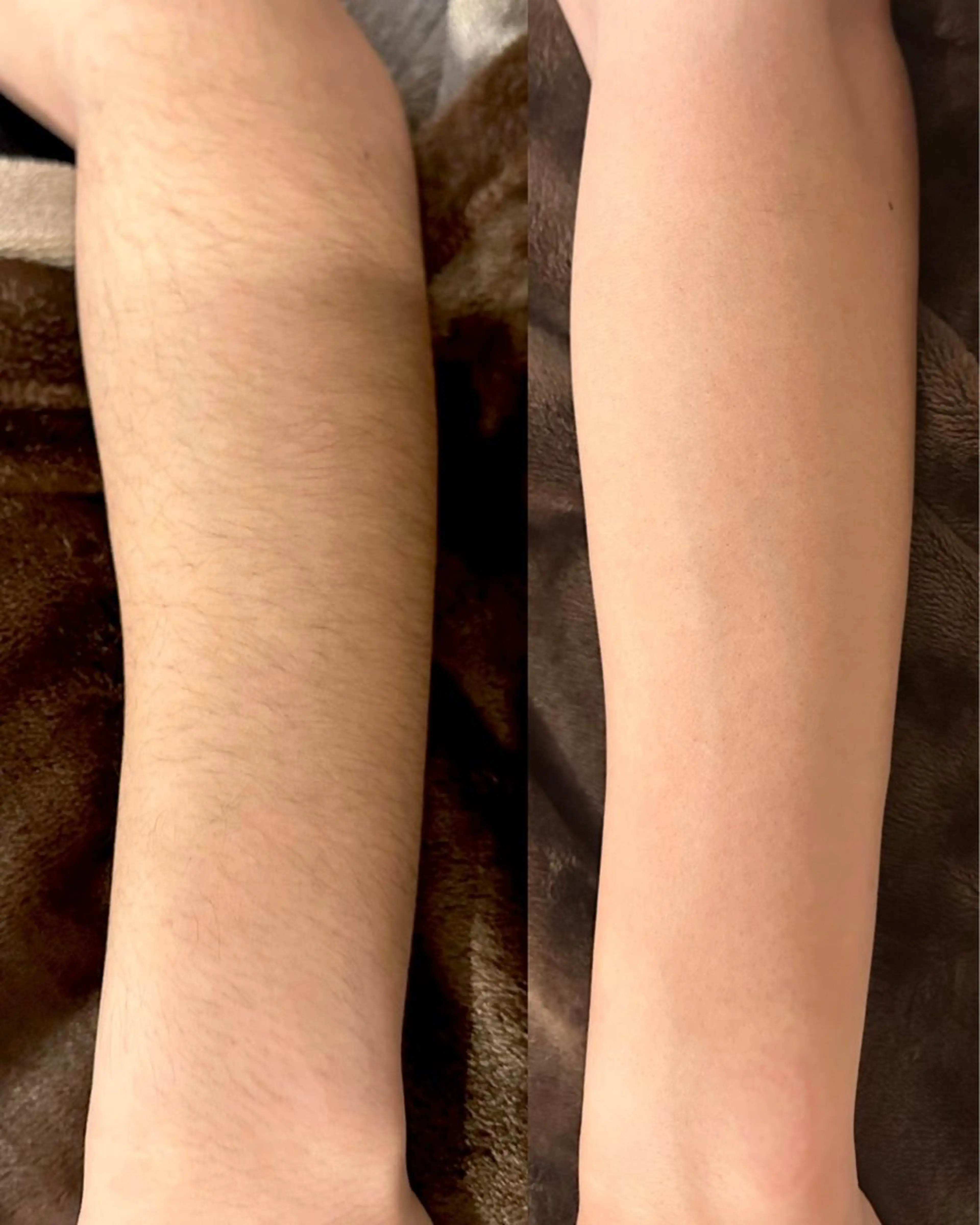 【高校生女子】自己処理ストレスから解放🪽腕脱毛(肩​〜​手首)¥4,400の写真