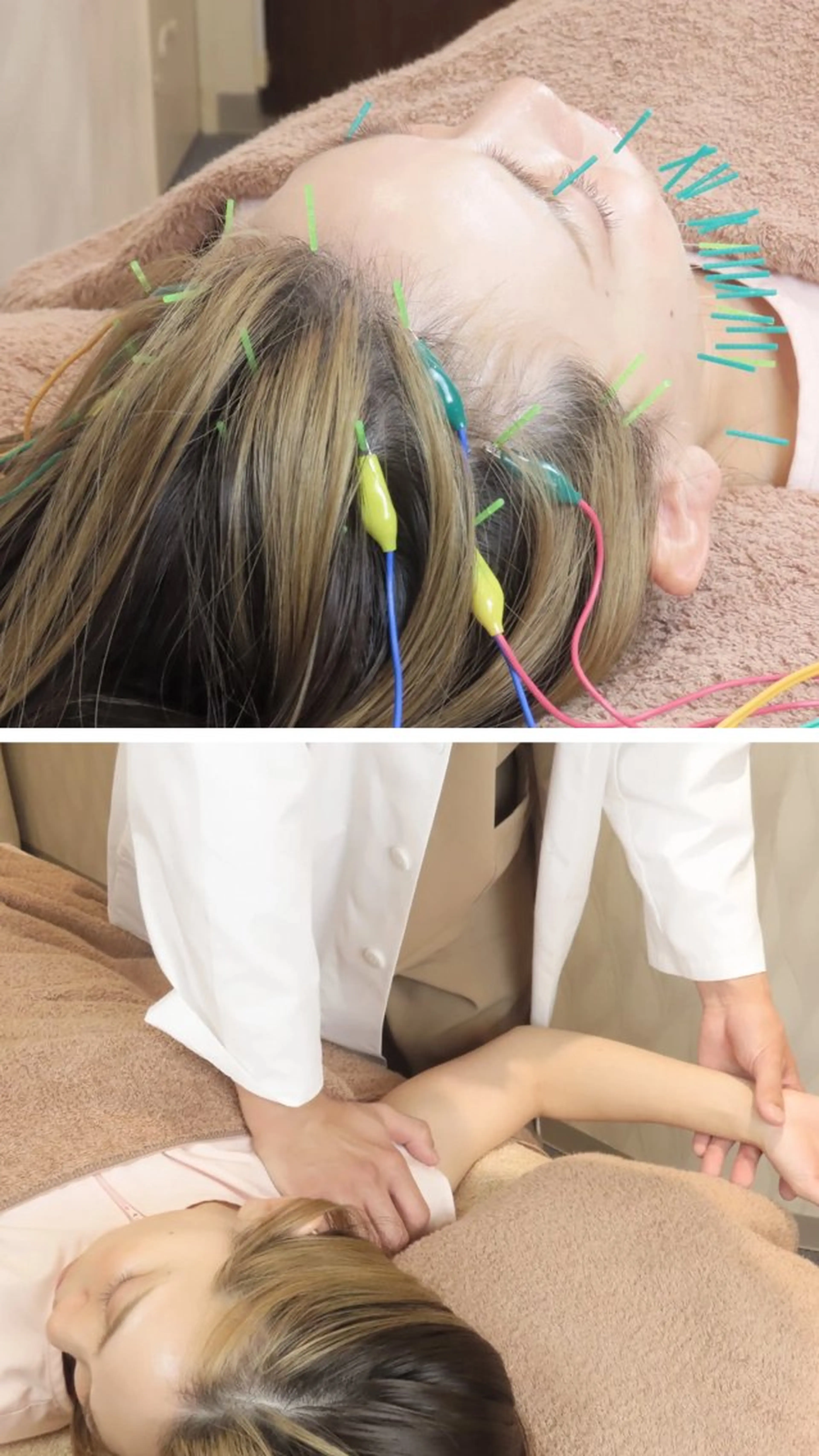 【お顔と体のお悩みに※口コミ必須】【小顔整顔美容鍼】鍼+電気パルス+整顔調整＋整体　120分の写真