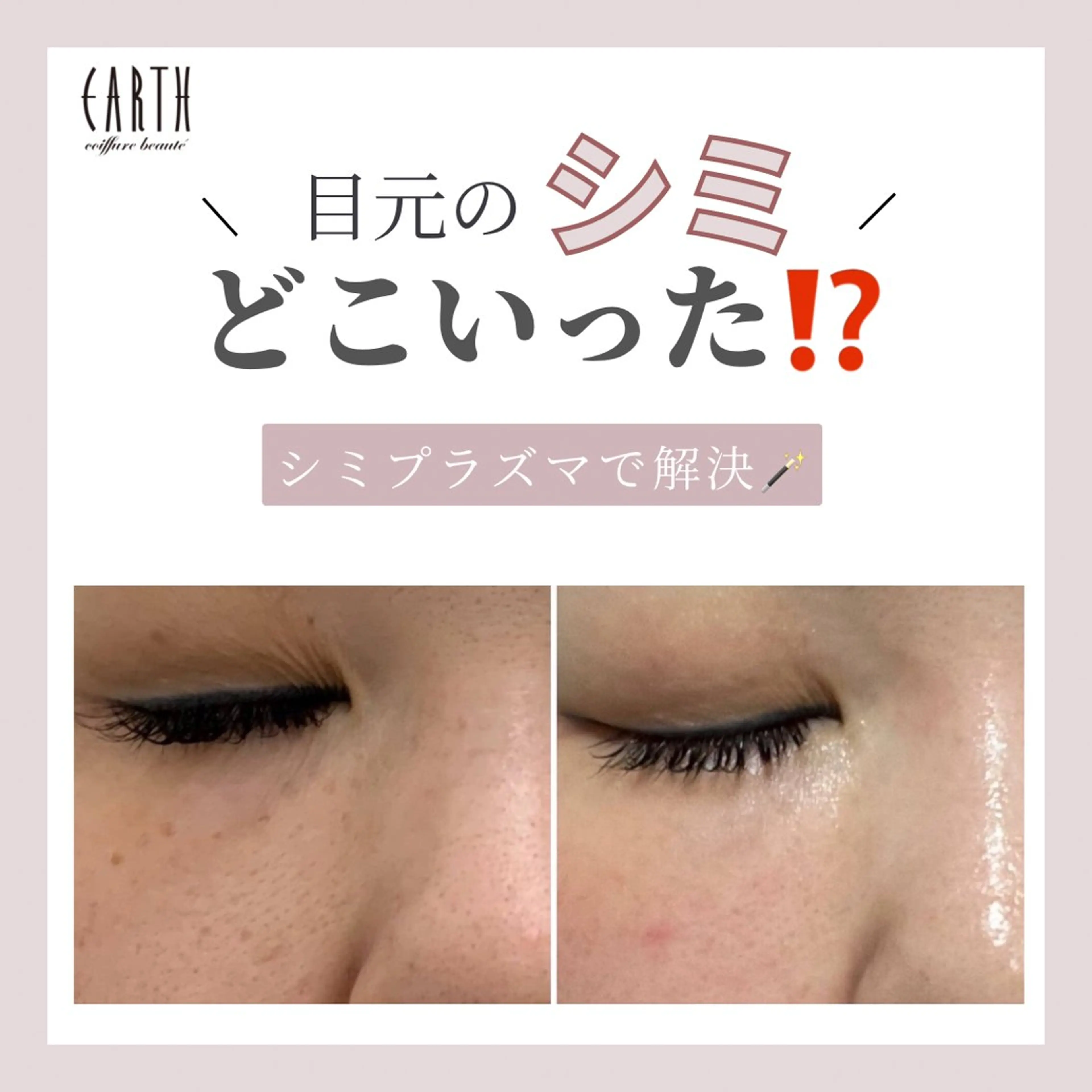 【最新シミ取り🪄＋プラズマシャワー🚿＋美容液導入】シミイボソバカス肝斑が気になる、ダウンタイムが出てもいい方◎の写真