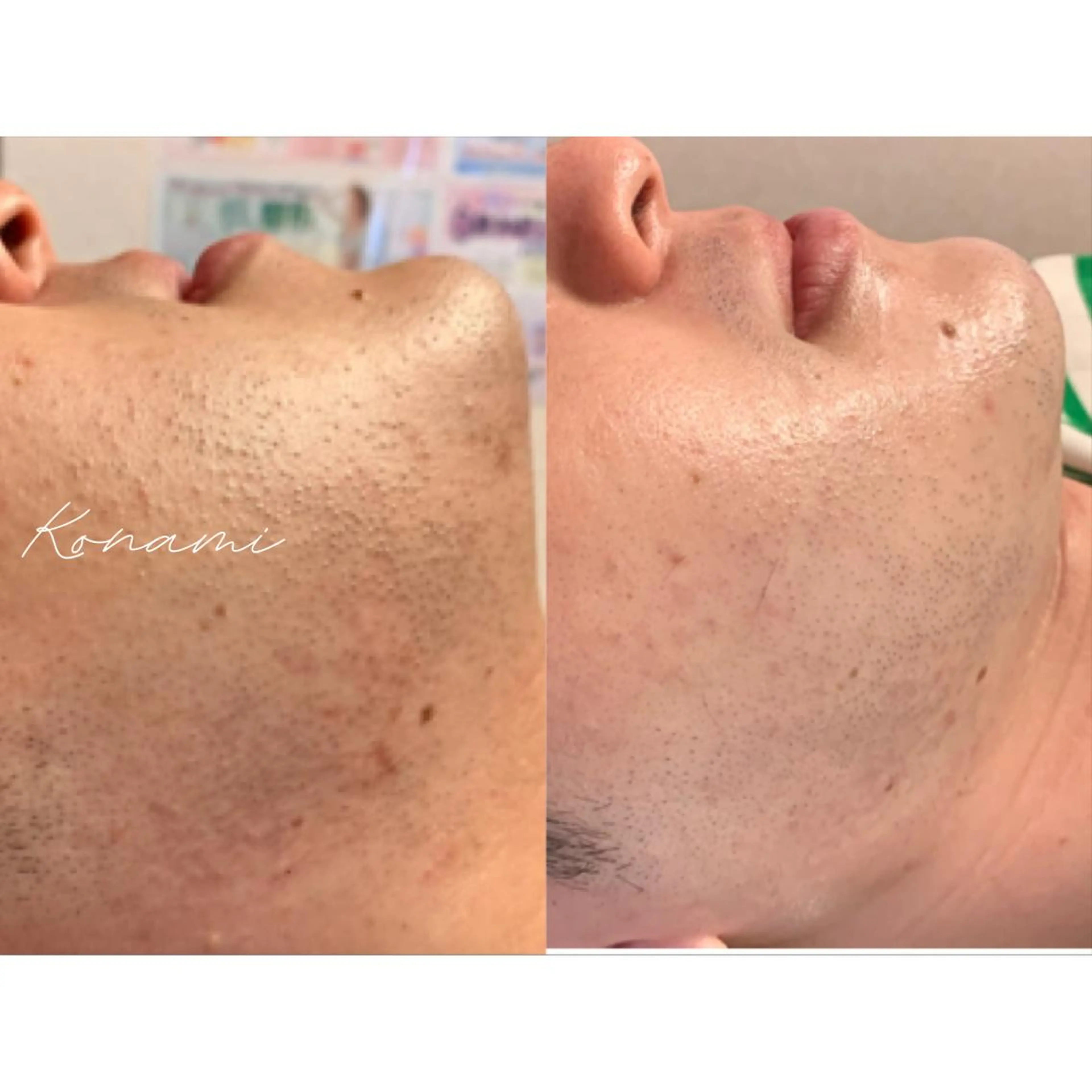 メンズ 脱毛 シードリン 府内店 小波のエステ・リラクイメージ