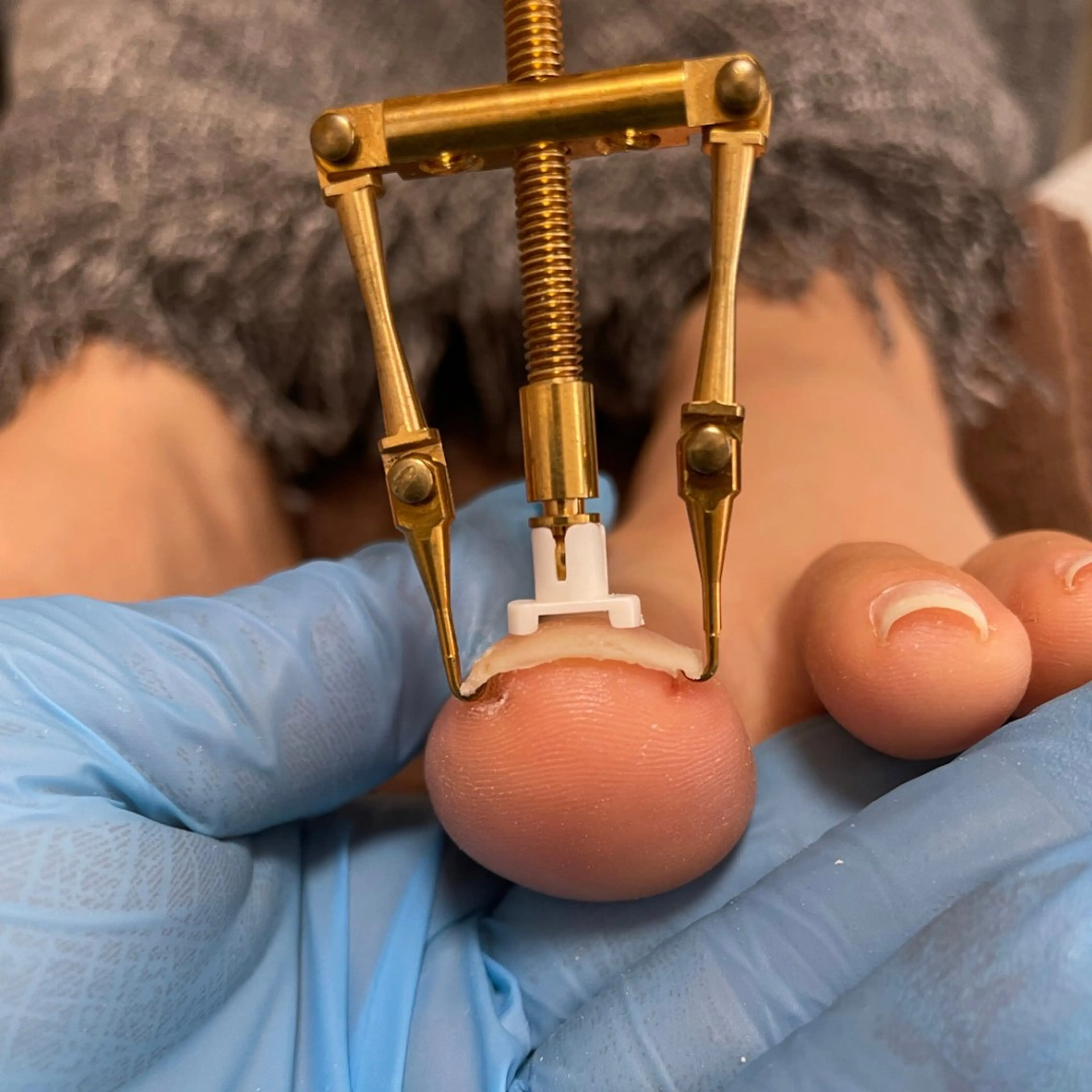 オフなしアクリル巻爪ケア1本の写真