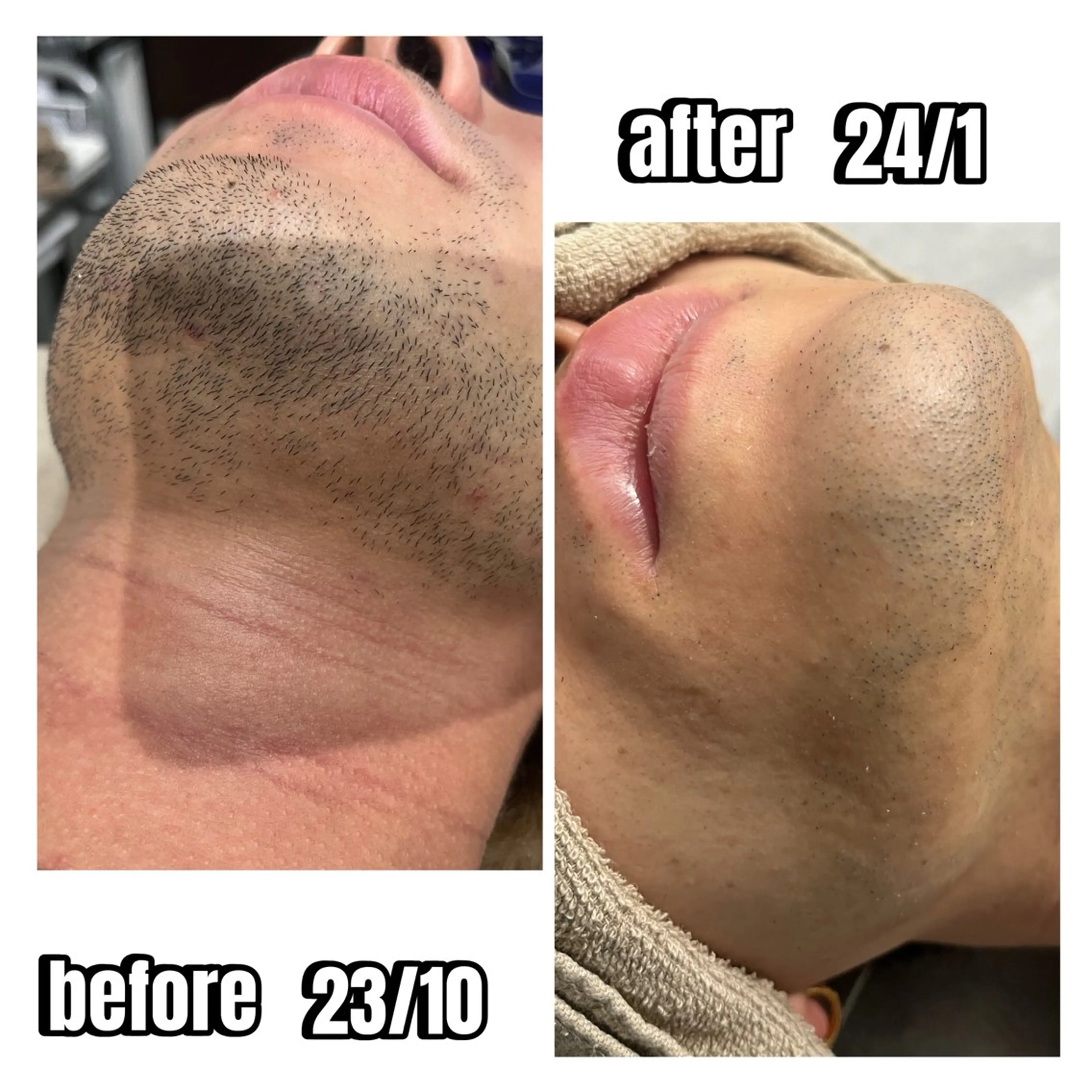 ✨顔・髭脱毛✨の写真