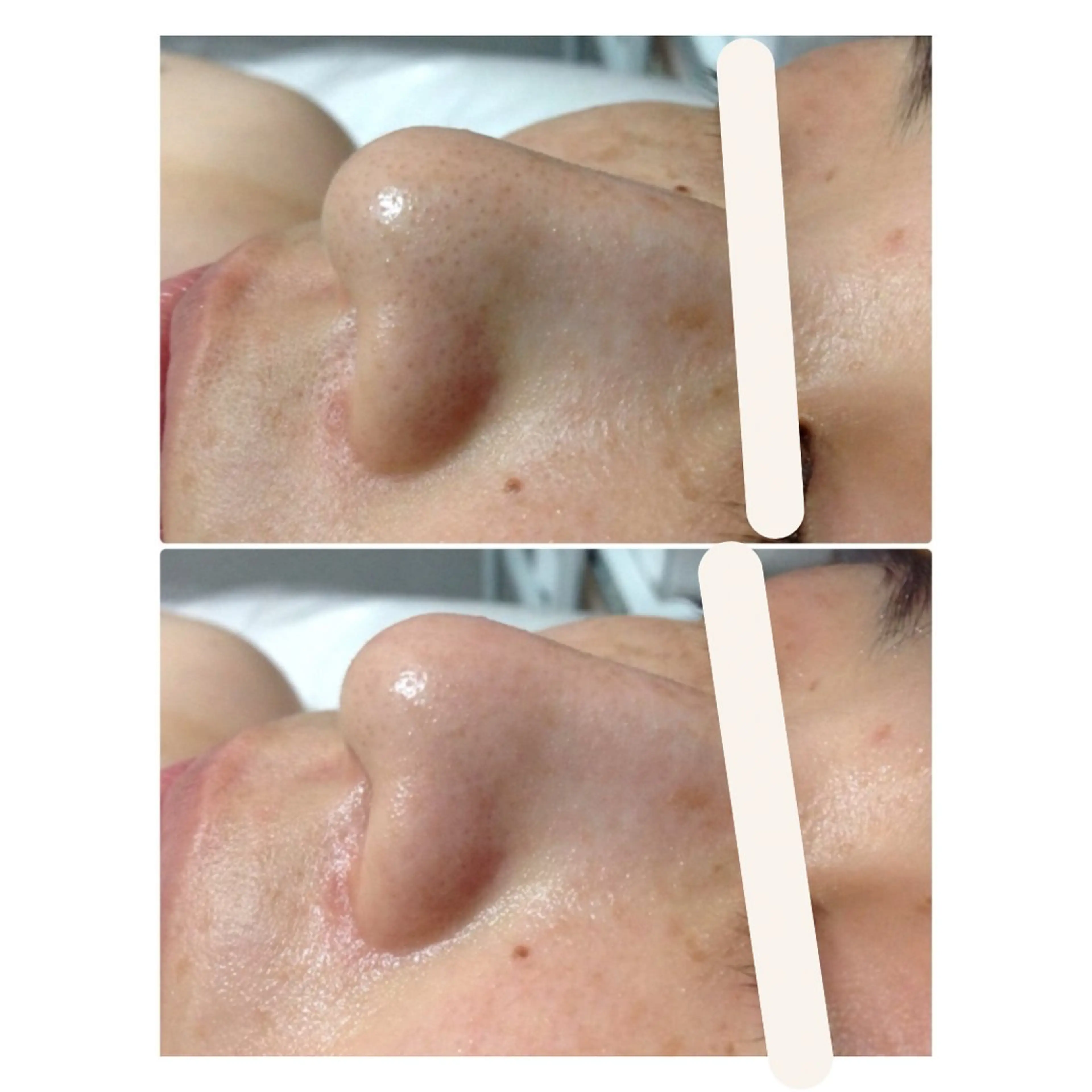 mens 《毛穴汚れ/くすみ》ハイドロフェイシャル毛穴洗浄&美容液導入EMSの写真