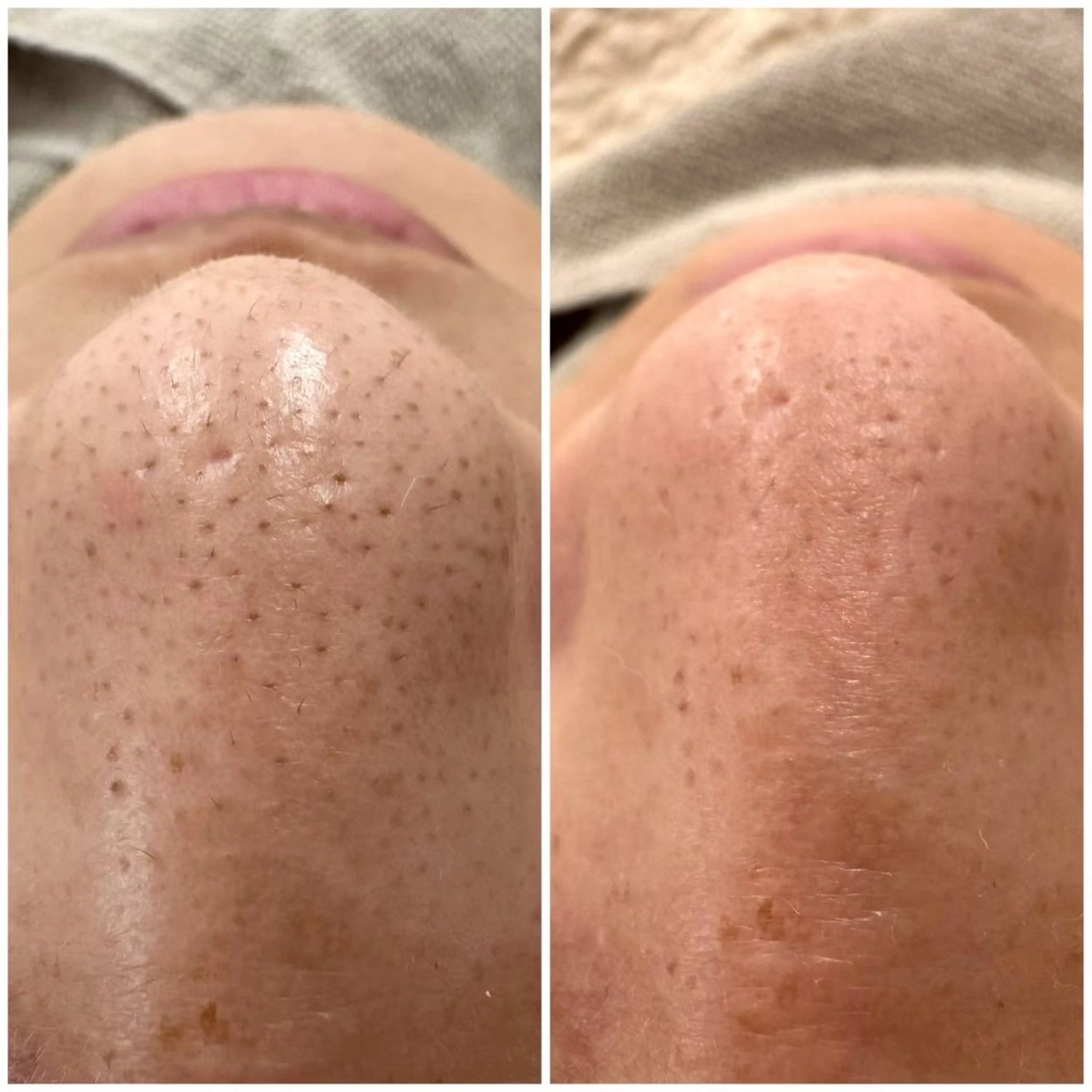 エステ EMILUCA HANA ꫂ ၴႅၴのその他イメージ