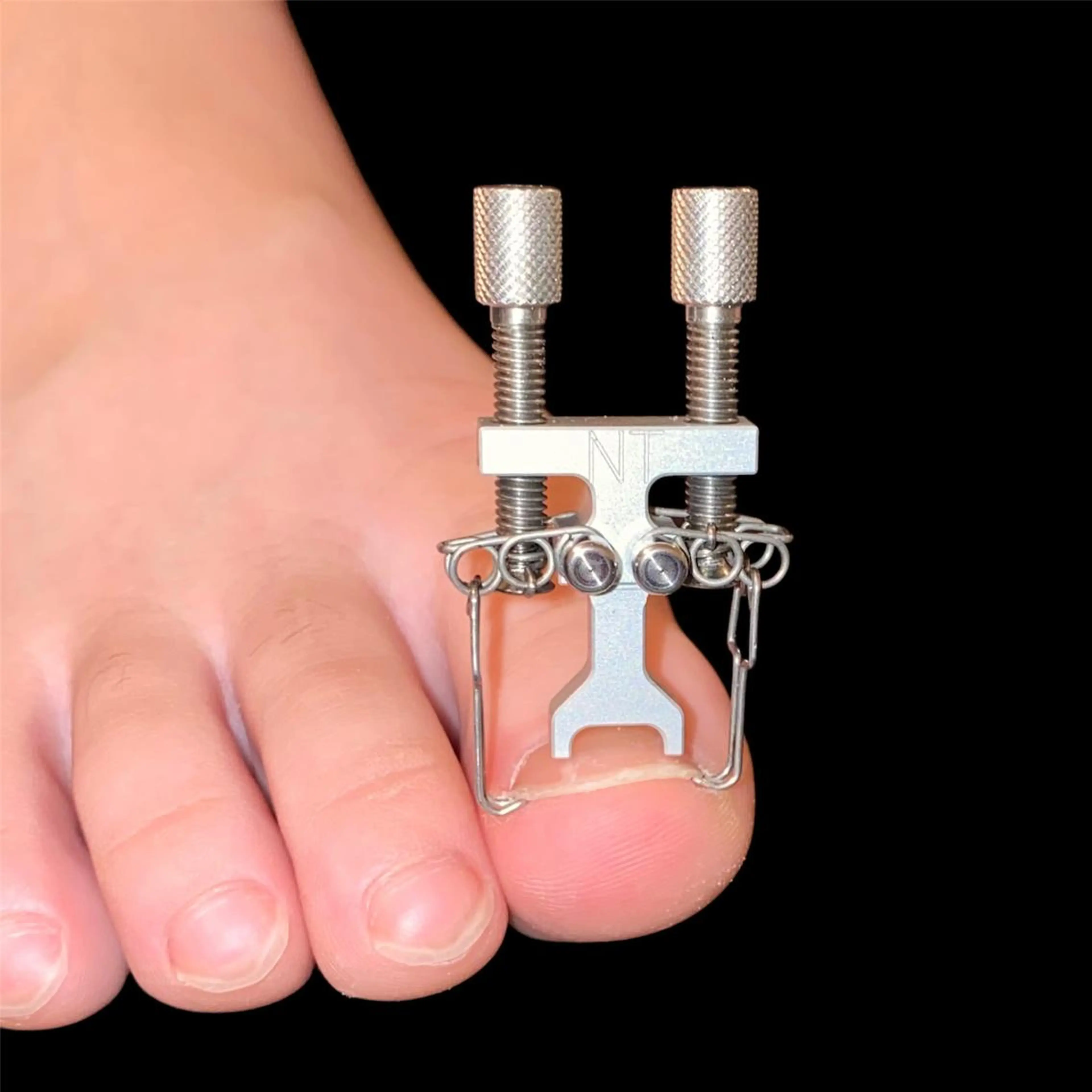 🦶巻き爪ケア・トラブルネイル(片足)の写真