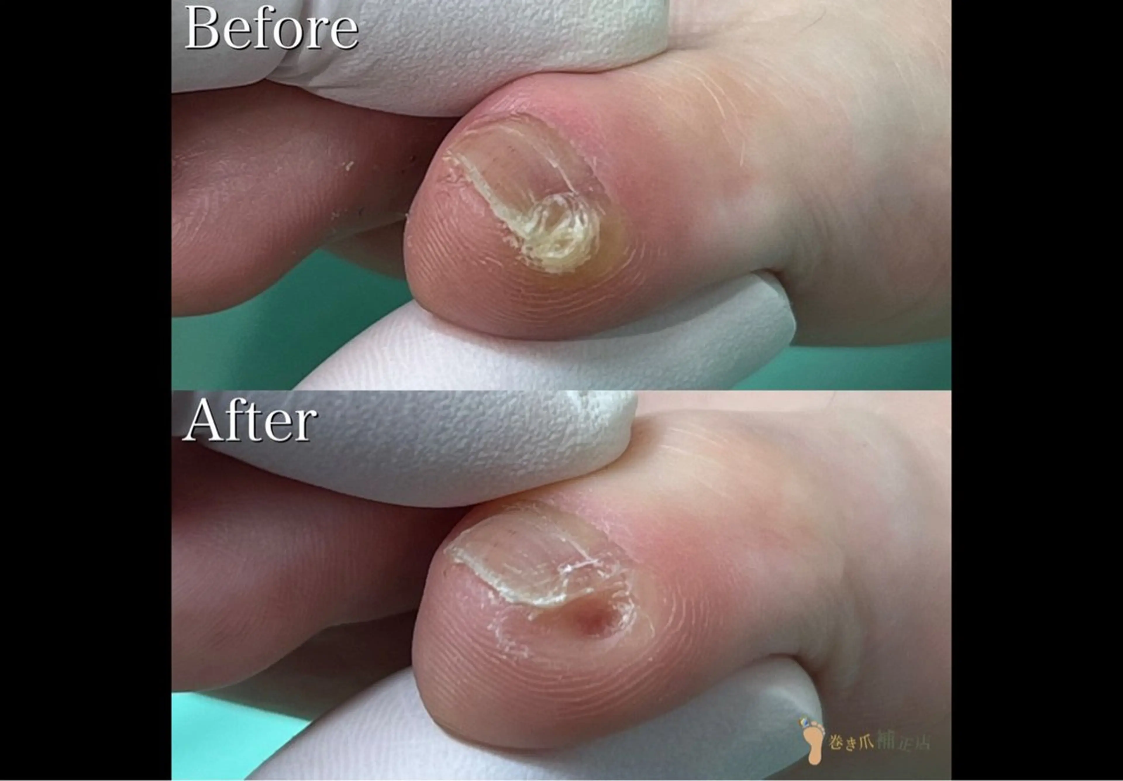 【副爪】副爪1爪ケア✨ひっかかりや見た目気になる方へおススメ❗️の写真